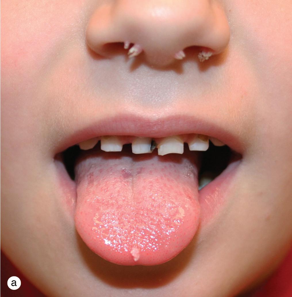 Fig. 5.4, Verruca vulgaris. Filiform warts developed on (a) the nose and tongue and (b) the ear of these children of school age.