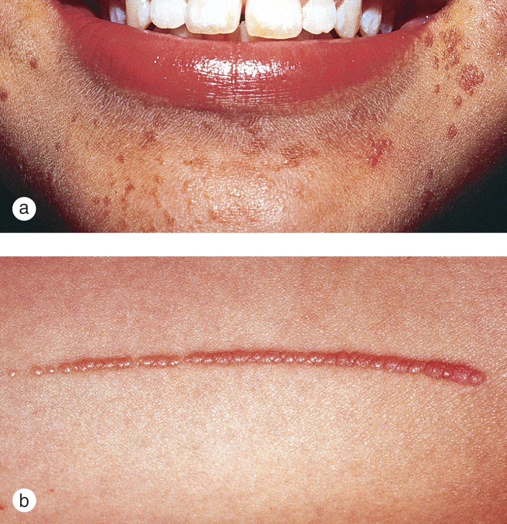 Fig. 5.5, Verruca plana. (a) The tiny, light-brown warts on the chin of a 12-year-old girl were spread by scratching. These asymptomatic warts were initially diagnosed as acne. (b) Flat warts were inoculated in a line on the flank of a 5-year-old girl.