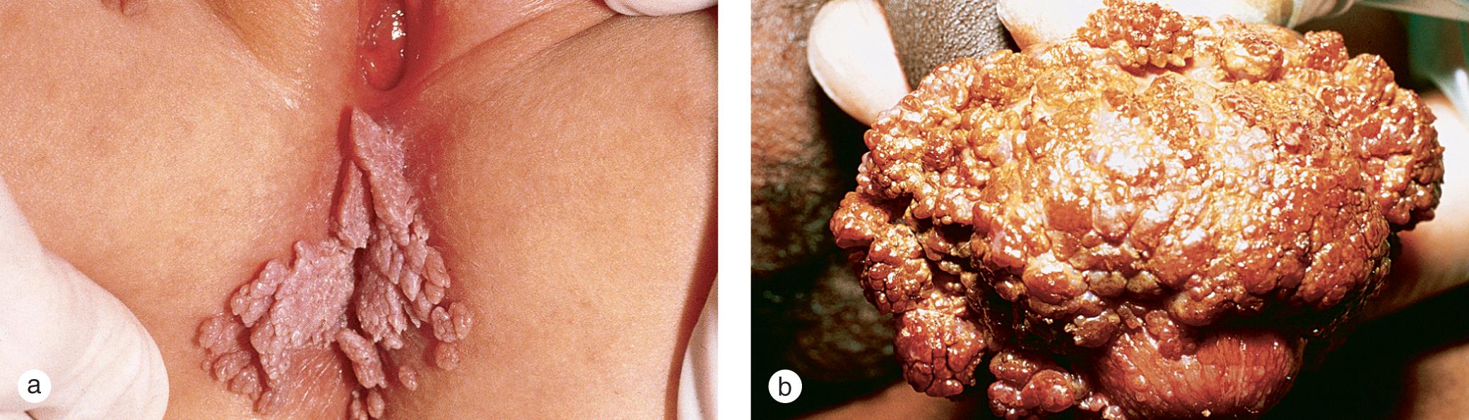 Fig. 5.6, Anogenital warts and condyloma. (a) The warts developed at 8 months of age in this infant whose mother had extensive vaginal and cervical papillomavirus infection at delivery. These lesions resolved after treatment with podophyllotoxin. (b) Large condyloma enveloped the glans penis of this adolescent boy.