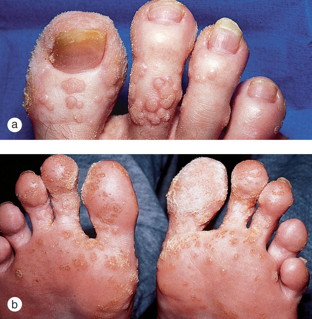 Fig. 5.7, Extensive, recalcitrant warts spread over (a) the top and (b) the bottom of the feet of a teenager with severe combined immunodeficiency.