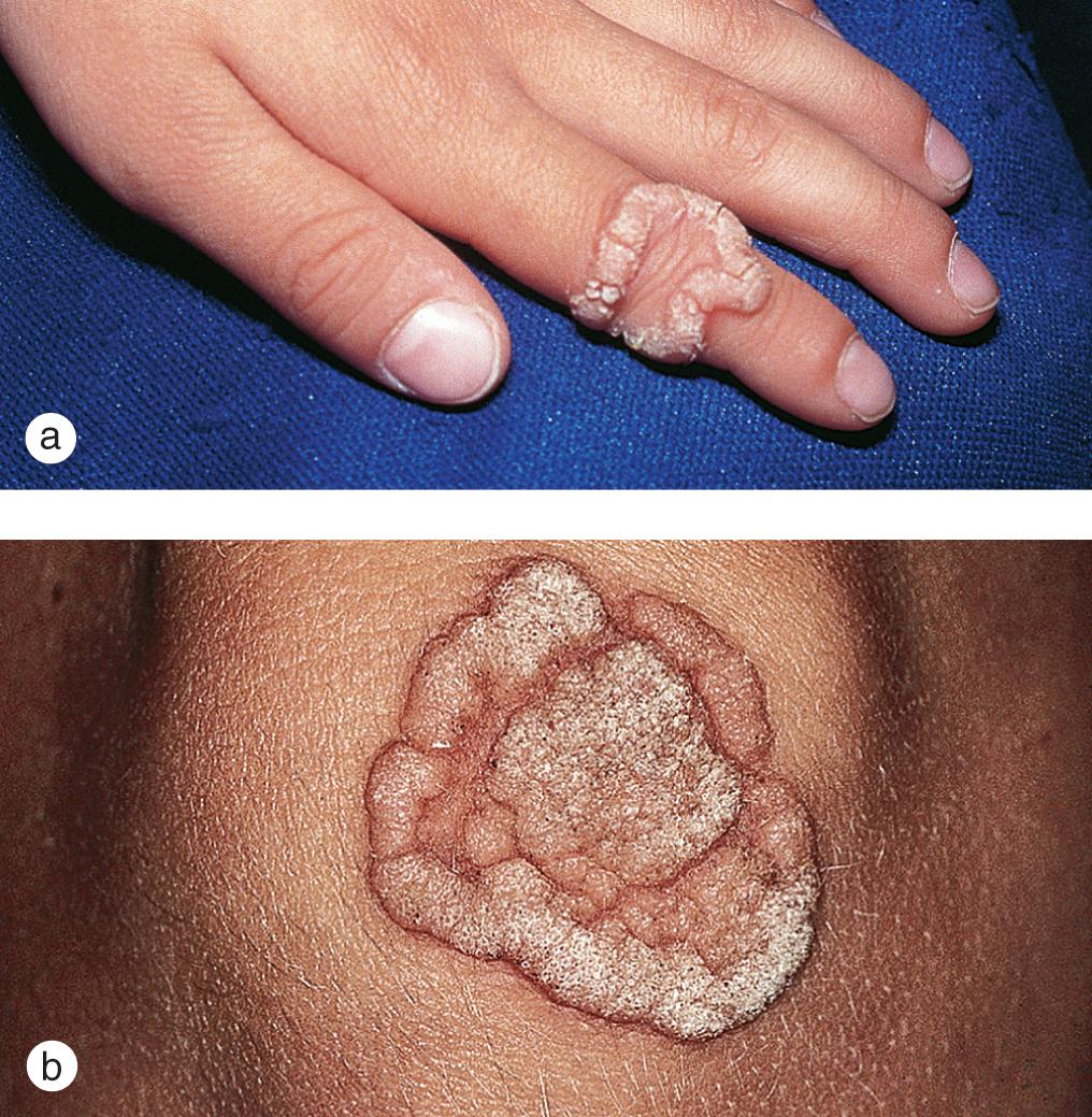 Fig. 5.8, Recurrence of warts. (a) A 10-year-old boy developed a recurrent ring wart after liquid nitrogen treatment of a large common wart on the index finger. (b) A 10-year-old girl had a similar complication after treatment of a wart on her knee.