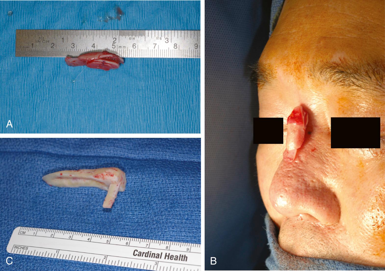 Fig. 33.3, Autogenous cartilage grafts for augmentation.