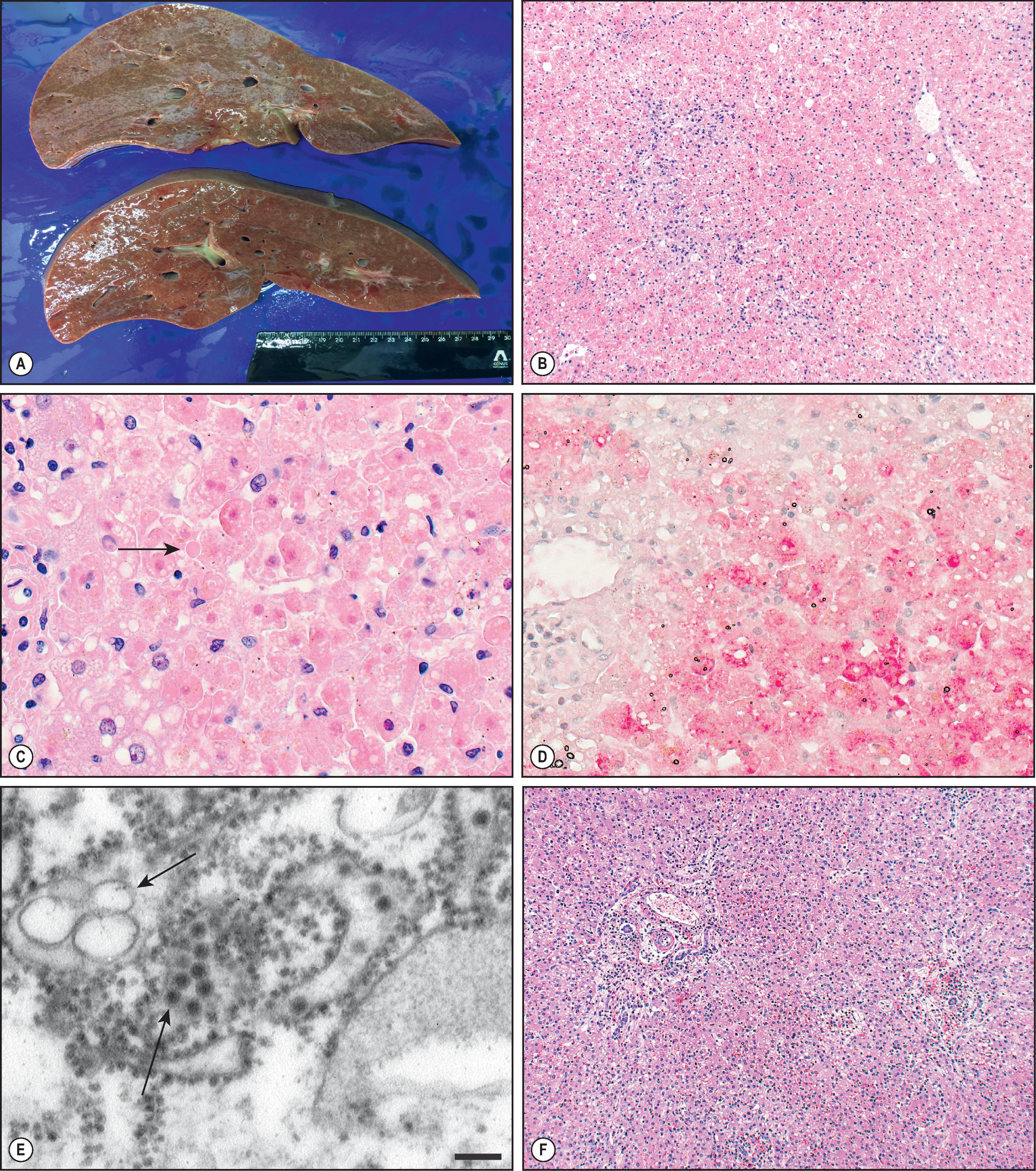 Figure 7.1, Yellow fever. (A) Gross image of liver in fatal case of yellow fever. (B) Extensive midzonal hepatic necrosis with minimal portal inflammation. (Haematoxylin and eosin [H&E] stain.) (C) High-power magnification with acidophilic (‘Councilman–Rocha Lima’) bodies (arrow) and small-droplet steatosis. (D) Immunohistochemical assay highlighting midzonal hepatocellular distribution of yellow fever viral antigens in red. (E) Virus particles (upper arrow) are seen in the rough endoplasmic reticulum. Virions are 40 nm in diameter with a dense core surrounded by the envelope. Also seen are smooth membrane vesicles (lower arrow), the replication complex for this virus. Bar represents 100 nm. (F) Portal-based inflammation and sinusoidal infiltrates in a case of yellow fever vaccine-associated viscerotropic disease. (H&E stain.)Figure 7.1 cont’d(G) Immunohistochemical assay highlighting distribution of yellow fever antigens in portal-based fibroblasts and Kupffer cells (immunoalkaline phosphatase staining, naphthol fast red substrate with haematoxylin counterstain). (H, I) Late-onset relapsing hepatitis associated with yellow fever showing (H) the typical pattern of ‘lobular hepatitis’ with apoptosis and spotty necrosis of hepatocytes; Kupffer cells are hypertrophic. (I) Confluent necrosis with mixed inflammation. Hypertrophic Kupffer cells are found in dilated sinusoids. (J) Immunohistochemical detection of YF antigen almost entirely restricted to the cytoplasm of hypertrophic Kupffer cells in an area of minimal lobular inflammation. (K) YF antigen more intensely immunostained in an aggregate of macrophages in a moderately inflamed hepatic lobule.