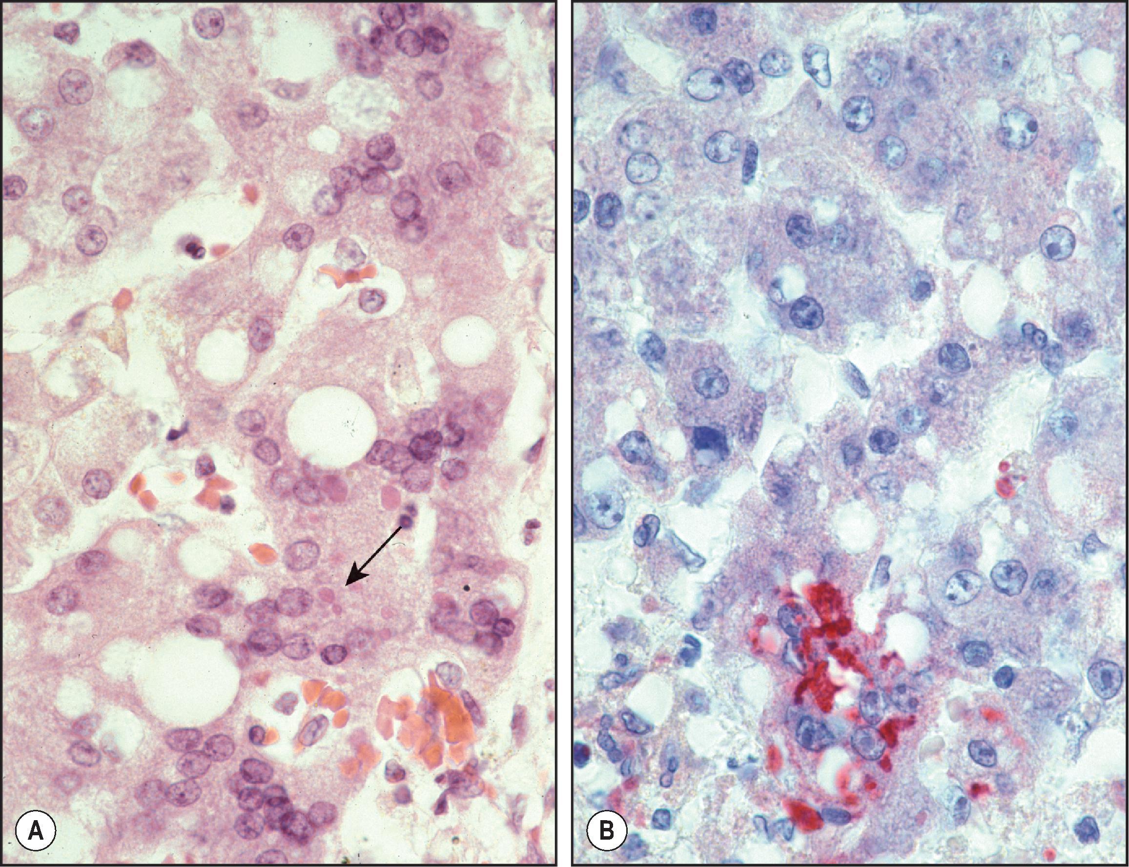 Figure 7.11, Measles virus. (A) Multinucleated hepatocytes with syncytial giant cell formation in measles. Note eosinophilic cytoplasmic (arrow) and nuclear inclusions. (B) Measles antigens in same hepatocytes as seen by immunohistochemistry. (Immunoalkaline phosphatase staining, naphthol fast red substrate with haematoxylin counterstain.)