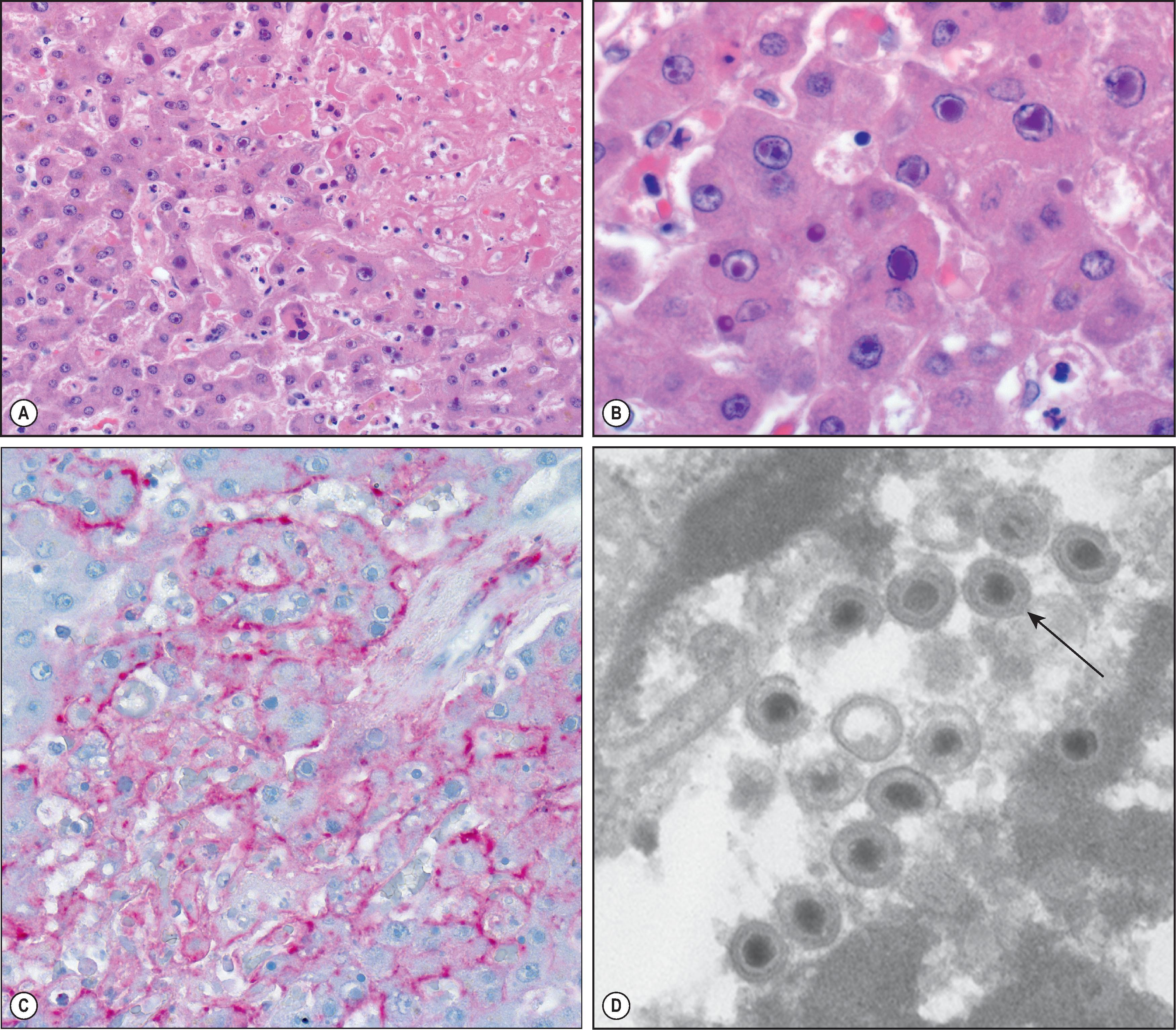 Figure 7.13, Varicella-zoster virus (VZV). (A) Liver from a fatal case of disseminated VZV showing confluent necrosis, congestion and numerous intranuclear viral inclusions. (B) Higher-power magnification of intranuclear inclusions. (H&E stain.) (C) Immunohistochemical staining of the same case showing abundant VZV antigens in necrotic areas (membrane staining seen with glycoprotein antibody) (immunoalkaline phosphatase staining, naphthol fast red substrate with haematoxylin counterstain). (D) Electron micrograph of herpes zoster virions (arrow) .