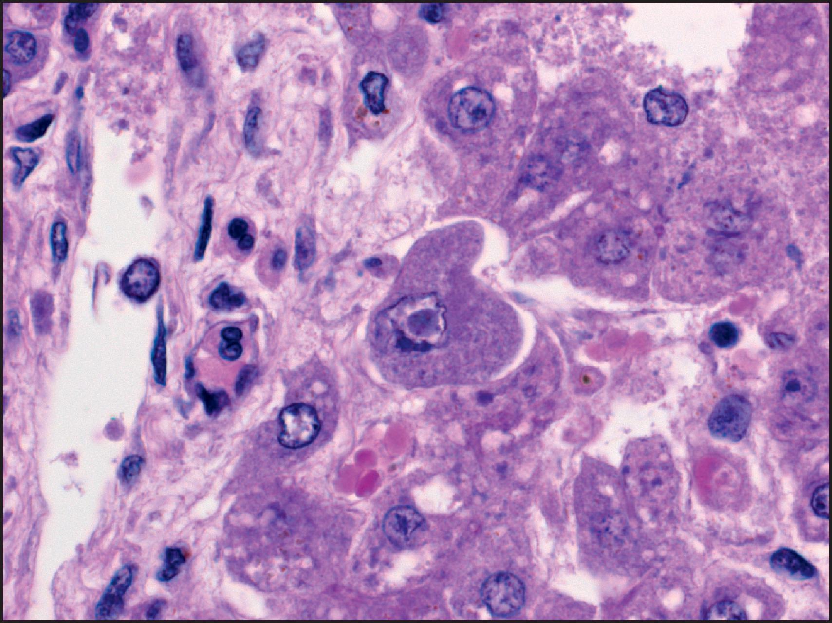 Figure 7.14, Cytomegalovirus infection. Intranuclear inclusions and no or little associated inflammation in the adjacent parenchyma. The basophilic material within the cytoplasm is also viral. (H&E stain.)