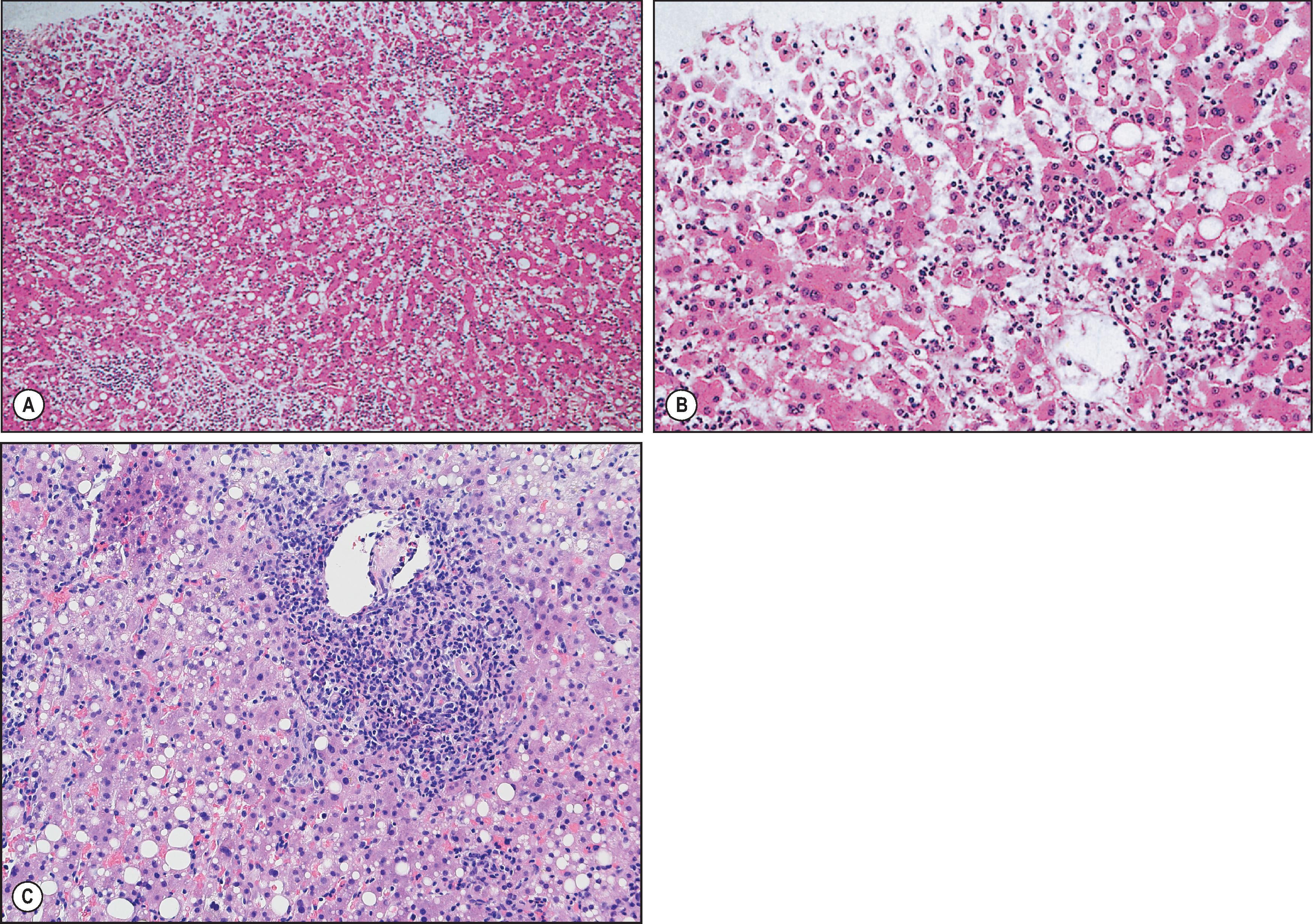 Figure 7.15, Epstein–Barr virus infection. (A) There is a diffuse portal tract and intra-acinar mononuclear cell infiltrate of the fatty liver. (B) Higher-power magnification showing perivenular focal liver cell necrosis and an intense intrasinusoidal mononuclear cell infiltrate. (C) Area of endophlebitis in an inflamed portal triad. (H&E stain.)