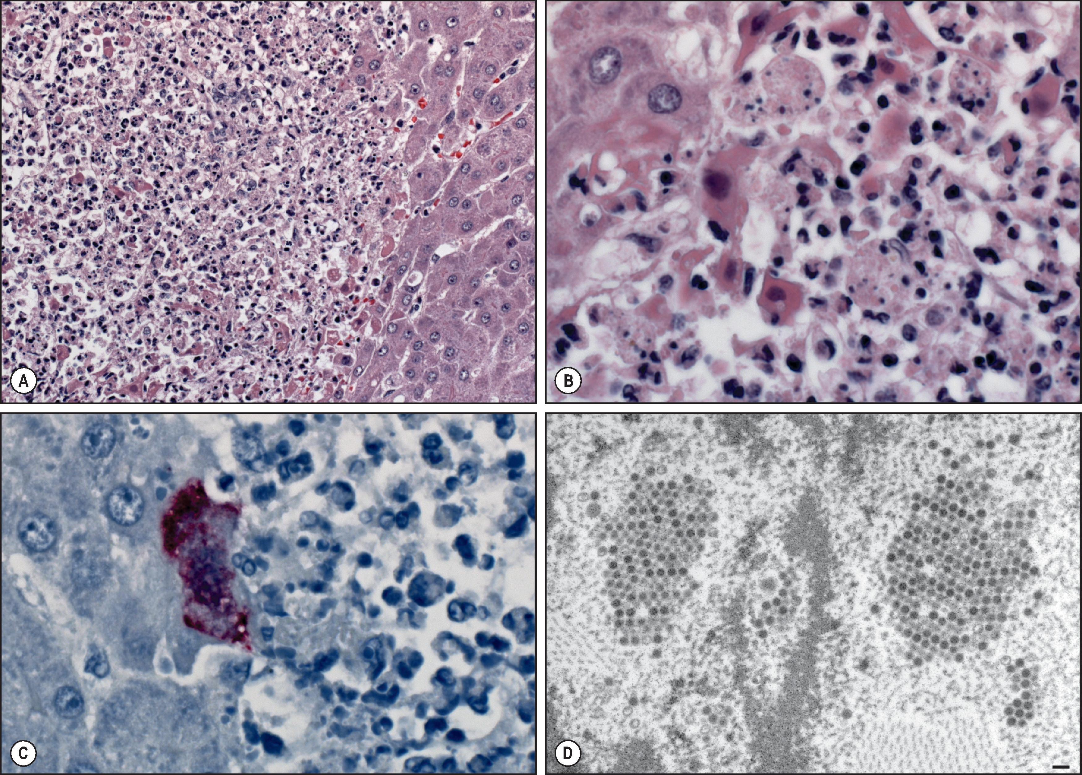 Figure 7.16, Adenovirus hepatitis. (A) Focal necrosis in liver of fatal adenovirus infection. Note abundance of mixed inflammatory cells and karyorrhectic debris. (B) Higher-power magnification of edge of necrotic area showing large basophilic intranuclear inclusions in hepatocytes, forming characteristic ‘smudge cells’. (H&E stain.) (C) Immunostaining of same area showing viral antigens in infected hepatocyte (immunoalkaline phosphatase staining, naphthol fast red substrate with haematoxylin counterstain). (D) Transmission electron micrograph showing intranuclear paracrystalline arrays of 70–90 nm adenovirus particles.