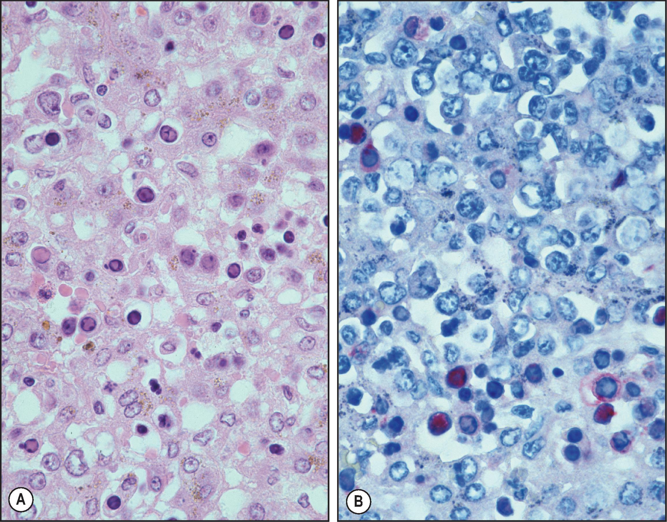 Figure 7.17, Parvovirus. (A) Photomicrograph showing extensive extramedullary haematopoiesis and haemosiderin deposition within hepatocytes and Kupffer cells. Numerous typical parvovirus B19 inclusions are seen in erythroid cells among areas of hepatic necrosis. Inclusions are typically intranuclear with eosinophilic ‘ground-glass’ appearance and ring-like margination of chromatin. Although not shown here, periportal fibrosis, bile duct reaction and cholestatic changes may be observed. (H&E stain.) (B) Confirmation and localization of parvovirus antigens using immunohistochemistry.