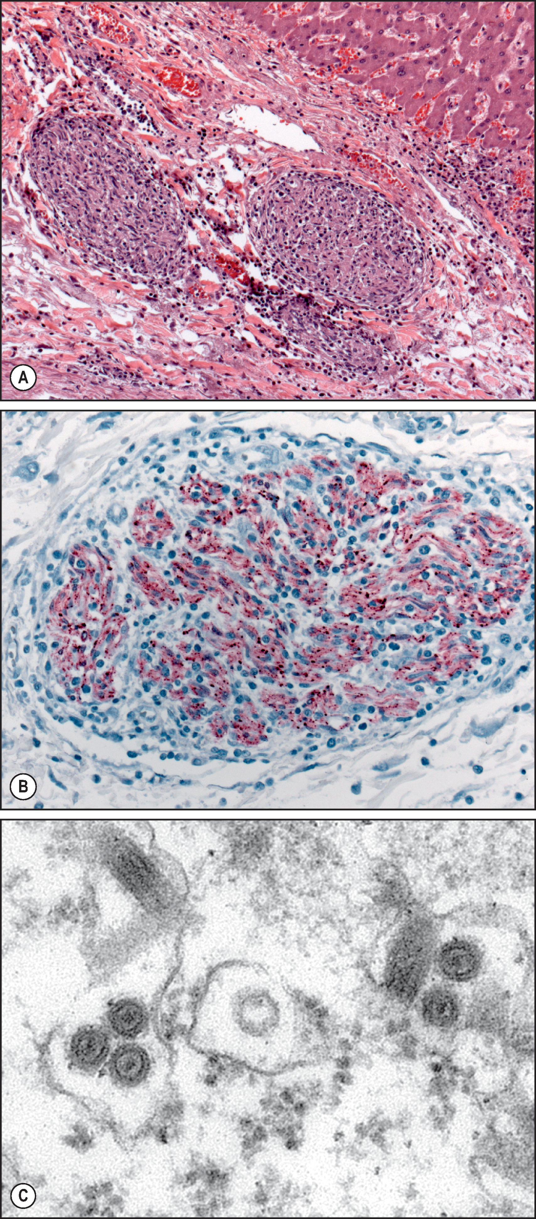 Figure 7.18, Rabies. Fatal case of rabies transmitted by an infected donor to a transplant recipient. (A) Connective tissue in the liver showing several peripheral nerves surrounded by an intense lymphohistiocytic infiltrate. (H&E stain.) (B) Immunohistochemical staining of rabies virus antigens in the same nerves (immunoalkaline phosphatase staining, naphthol fast red substrate with haematoxylin counterstain). (C) Filamentous rhabdovirus particles, averaging about 65 nm, sectioned both longitudinally and transversally as seen by thin-section electron micrograph in brain of a suckling mouse inoculated with CNS tissue from the organ transplant recipient.