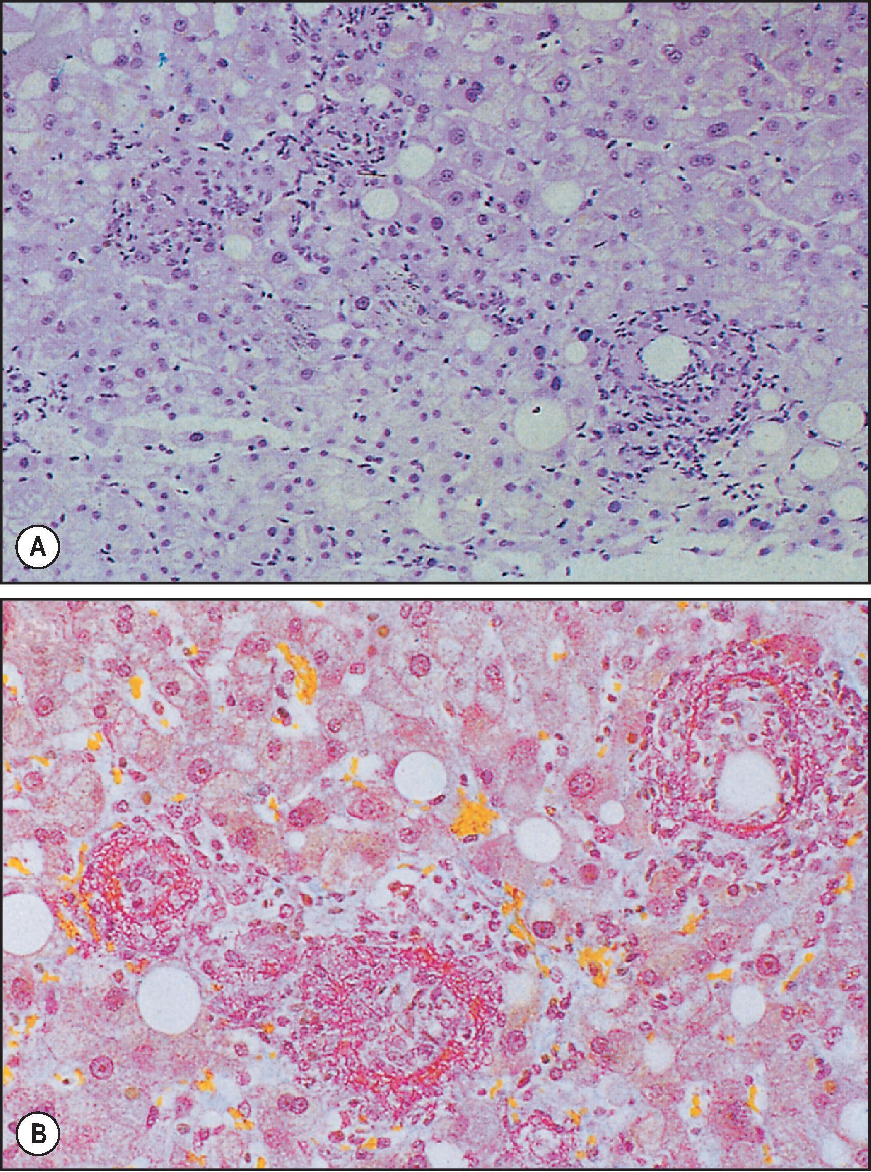 Figure 7.19, Liver biopsy from a patient with proven Q fever. (A) The granulomas have a central fatty vacuole and the surrounding macrophages are trapped in a mesh of fibrin. (H&E stain.) (B) This is better seen on a Martius, scarlet and blue (MSB) stain.