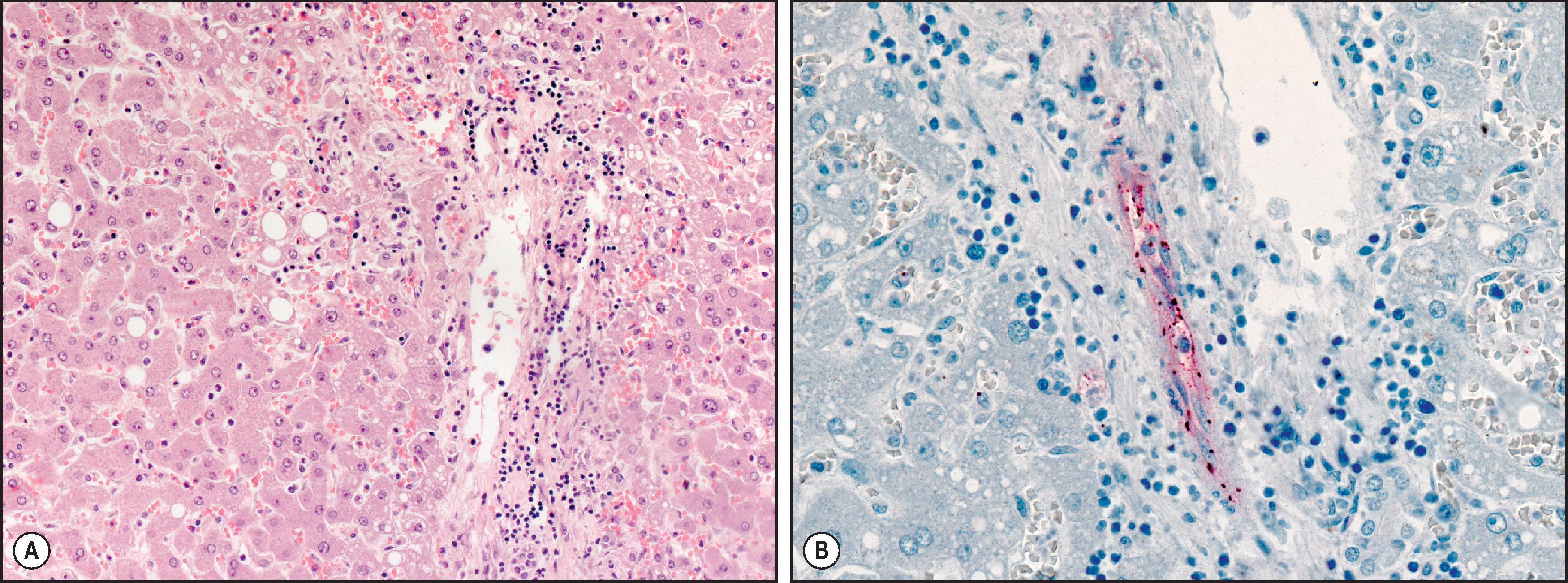 Figure 7.20, Rocky Mountain spotted fever. (A) Liver showing portal inflammation and vasculitis. Vessels are surrounded by a mixed inflammatory cell infiltrate predominantly lymphohistiocytic in nature. (H&E stain.) (B) Immunohistochemical localization of spotted fever rickettsial antigens as seen in blood vessel in portal tract of liver. Antigens appear as coccobacilli within vascular endothelium. (Immunoalkaline phosphatase staining, naphthol fast red substrate with haematoxylin counterstain.)