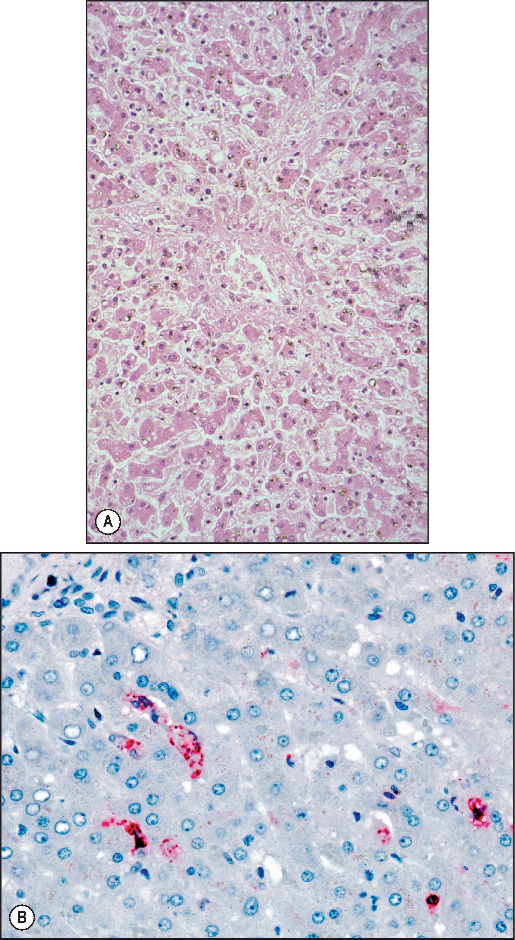 Figure 7.2, Dengue. (A) Paracentral hepatic necrosis and sinusoidal congestion. Note intact rim of hepatocytes surrounding central venule. (B) Immunostaining of liver showing focal viral antigens within Kupffer cells. Note the absence of staining of hepatocytes. (Immunoalkaline phosphatase staining, naphthol fast red substrate with haematoxylin counterstain.)