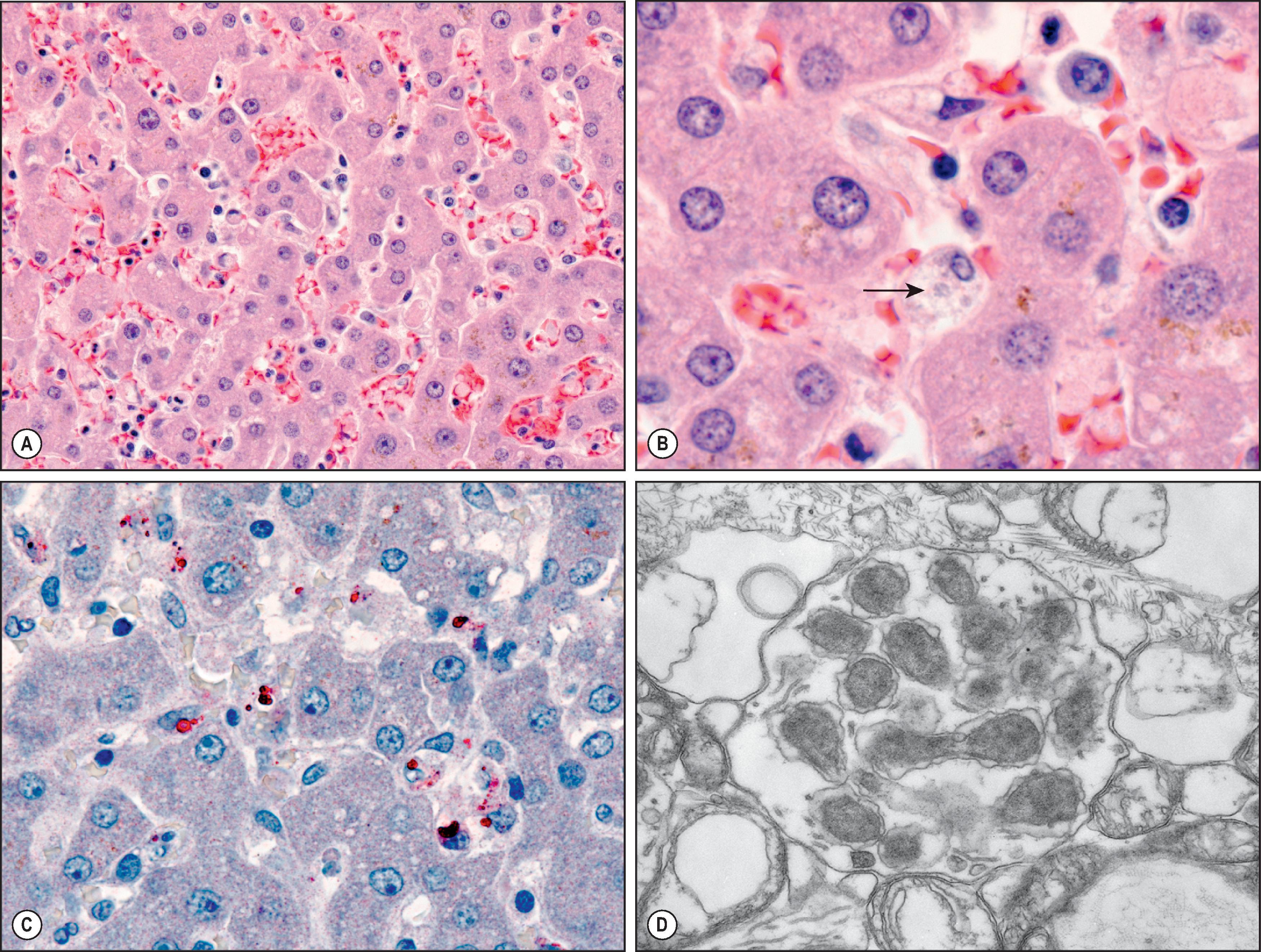 Figure 7.21, Ehrlichiosis. (A) Liver showing Kupffer cell hyperplasia, congestion and intrasinusoidal foamy histiocytes. (B) High-power photomicrograph showing a possible intracellular morula (arrow) and foamy histiocytes. However, intracellular granules may have a similar appearance, and confirmation with immunohistochemical and molecular assays is essential. (H&E stain.) (C) Immunohistochemical localization of Ehrlichia antigens in Kupffer cells and monocytes in hepatic sinusoids. Ehrlichia chaffeensis organisms are seen as intracellular inclusions. (Immunoalkaline phosphatase staining, naphthol fast red substrate with haematoxylin counterstain.) (D) Typical E. chaffeensis pleomorphic coccoid and bacillary forms within a cytoplasmic vacuole as seen by electron microscopy in tissue culture.