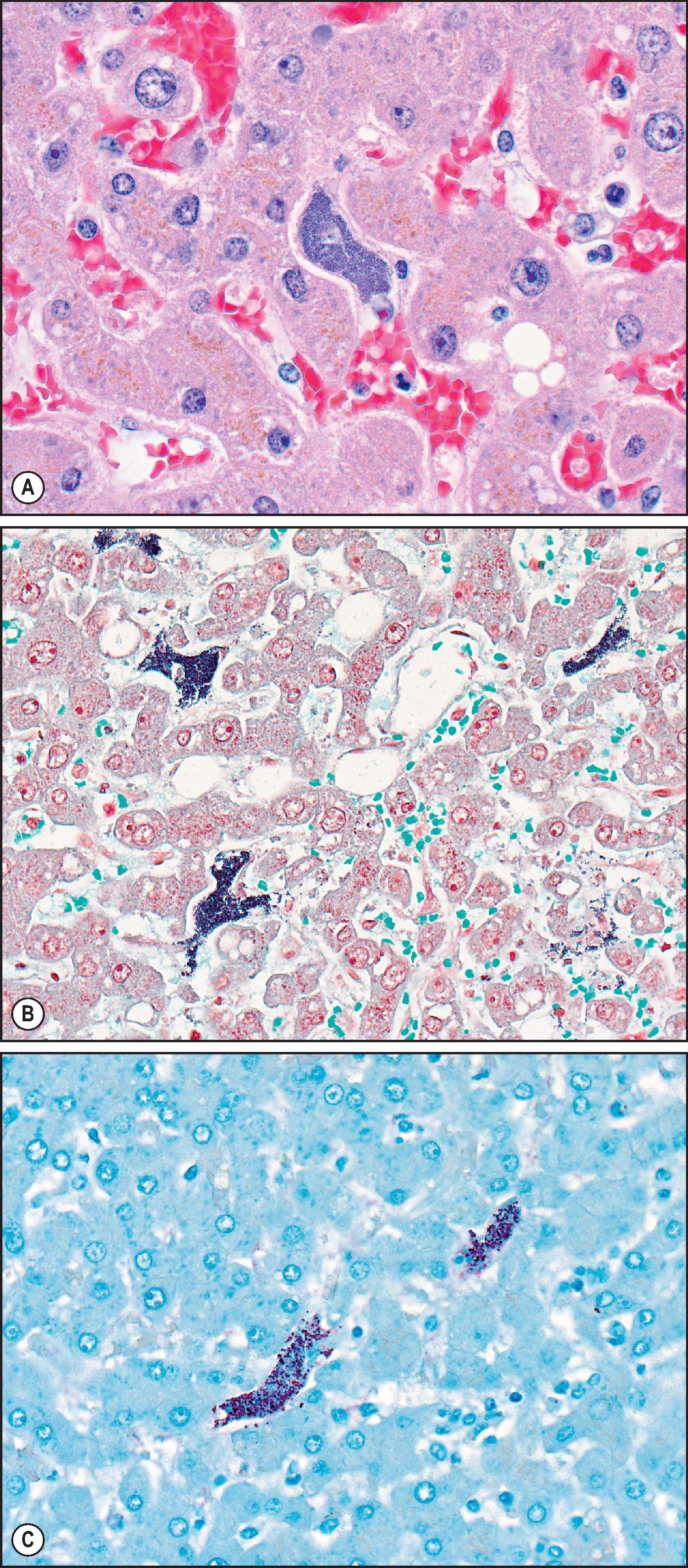 Figure 7.22, Group A streptococcus ( Streptococcus pyogenes ). (A) Liver in fatal septicaemia associated with group A streptococcal infection; note intrasinusoidal bacteria and leukocytes. (H&E stain.) (B) Abundant Gram-positive cocci, some in pairs and chains, within the sinusoids. (Gram stain.) (C) Immunohistochemical assay demonstrating abundant group A streptococcal antigens (immunoalkaline phosphatase staining, naphthol fast red substrate with haematoxylin counterstain).