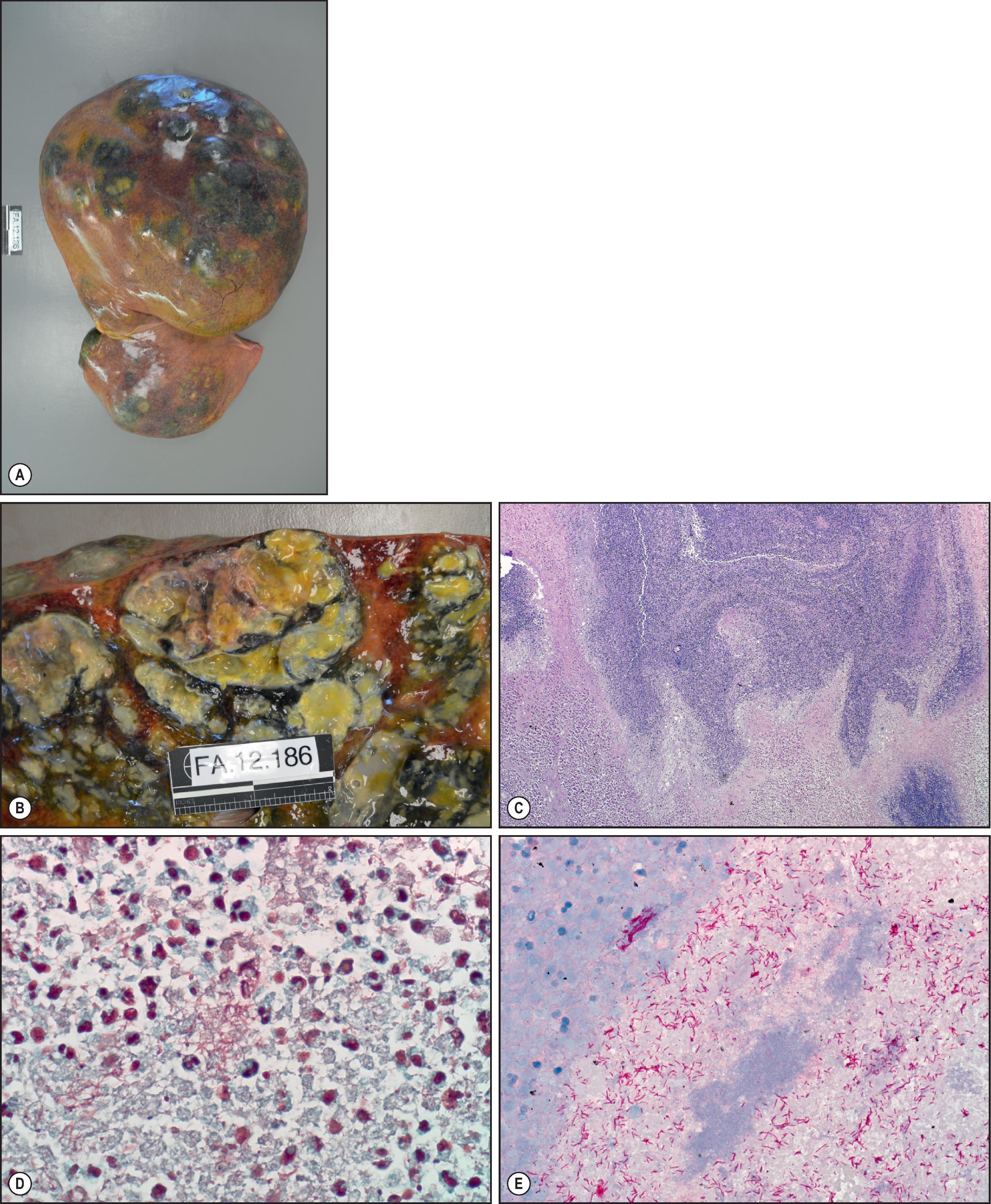 Figure 7.23, Disseminated Fusobacterium spp. (A) The liver at autopsy in a fatal case of disseminated Fusobacterium . Numerous abscesses are visible along the hepatic surface and on cut section (B). (C) Irregular zone of necrosis and suppuration. (H&E stain.) (D) Lillie–Twort Gram stain highlights numerous fusiform rod-shaped bacteria. (E) Immunohistochemical assay using an antibody that reacts with Fusobacterium spp. demonstrates abundant bacteria within the abscess.