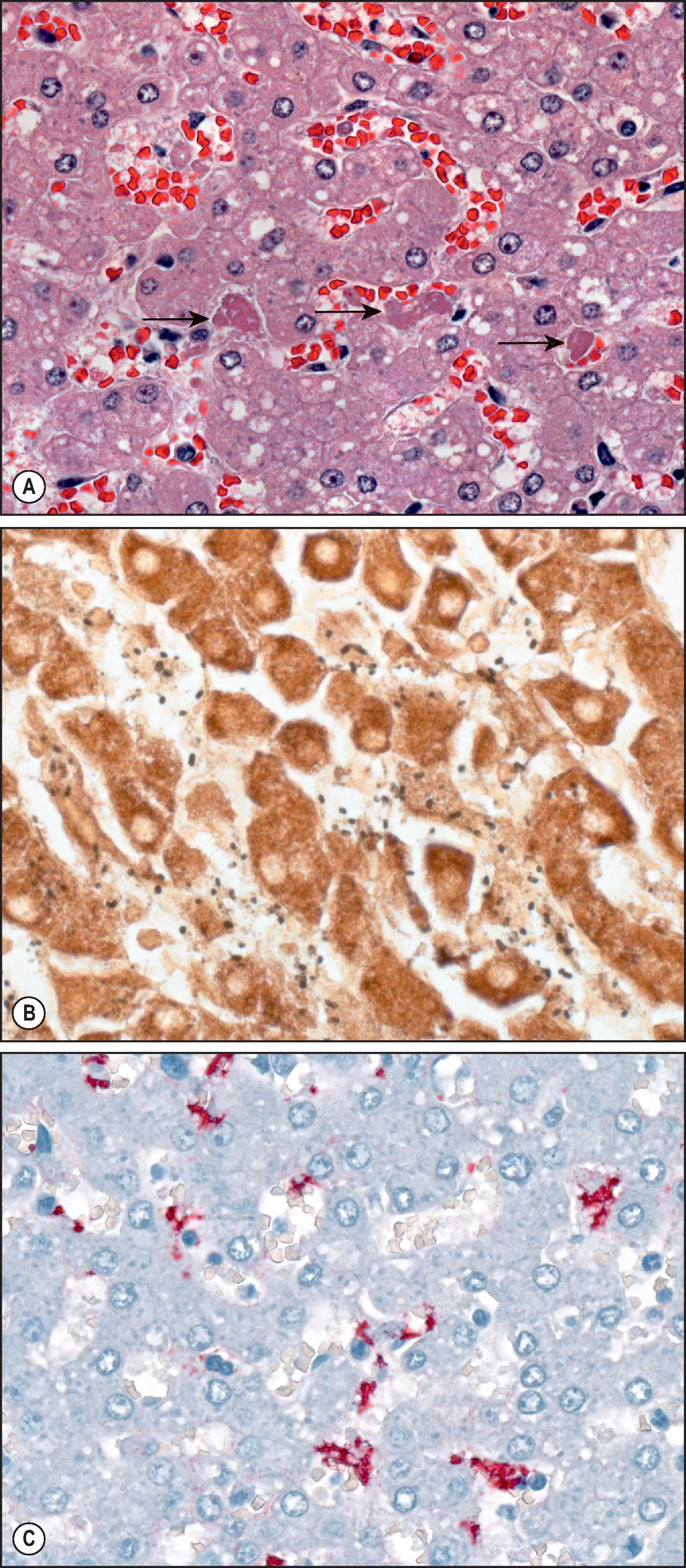 Figure 7.24, Yersinia pestis . (A) Liver with sinusoidal congestion, fibrin thrombi (arrows) and mild inflammation. (H&E stain.) (B) Although Gram stain can reveal abundant Gram-negative coccobacilli within sinusoids, the stain was noncontributory in this case, and bacteria were identified by a silver stain (Steiner). (C) Y. pestis bacteria and bacterial antigens as seen within Kupffer cells by immunohistochemistry. (Immunoalkaline phosphatase staining, naphthol fast red substrate with haematoxylin counterstain.)