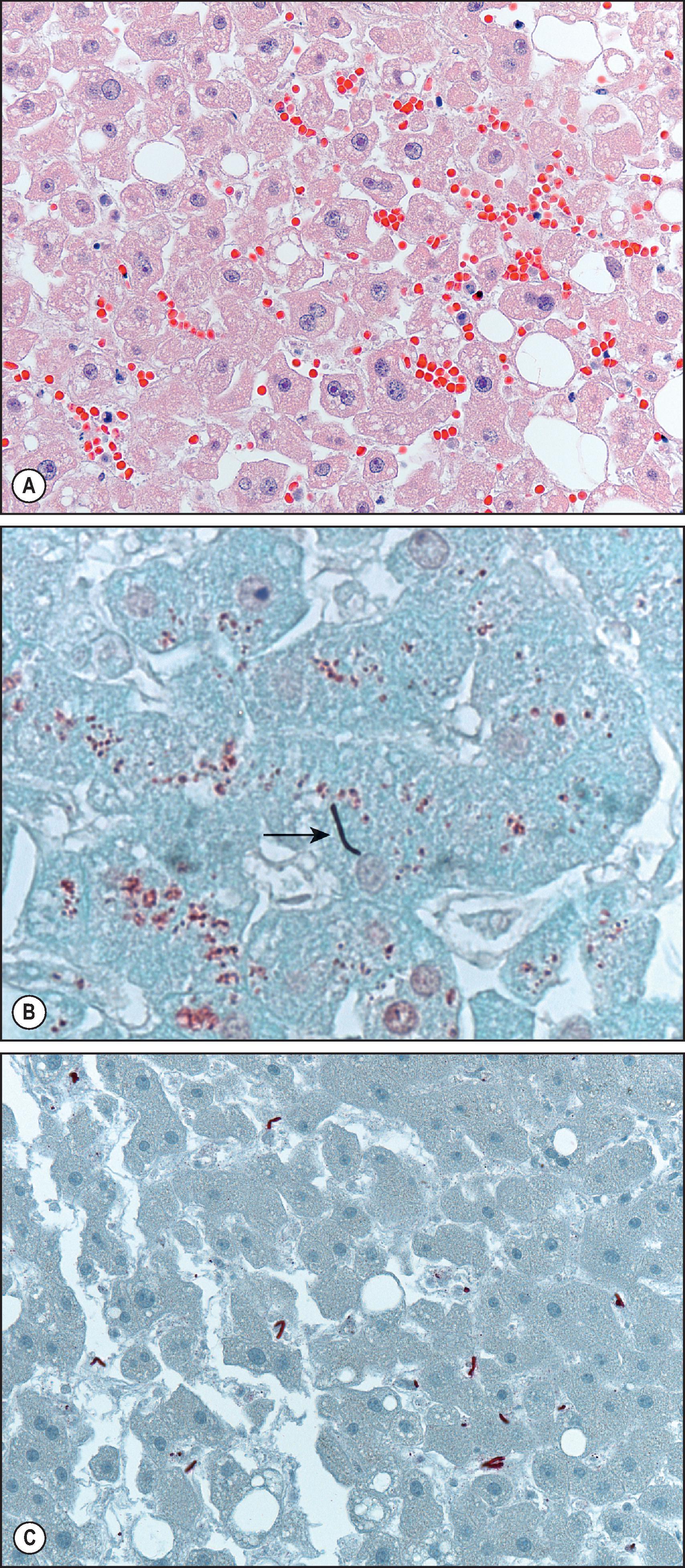 Figure 7.26, Bacillus anthracis (anthrax). (A) Low-power photomicrograph of liver in a fatal case of inhalational anthrax with secondary septicaemia. Note focal degeneration and necrosis of hepatocytes and haemorrhage and lack of inflammatory response. (H&E stain.) (B) Single Gram-positive bacillus is seen in this photomicrograph (arrow). (C) Immunohistochemical assay for B. anthracis cell wall showing multiple bacilli in hepatic sinusoids.