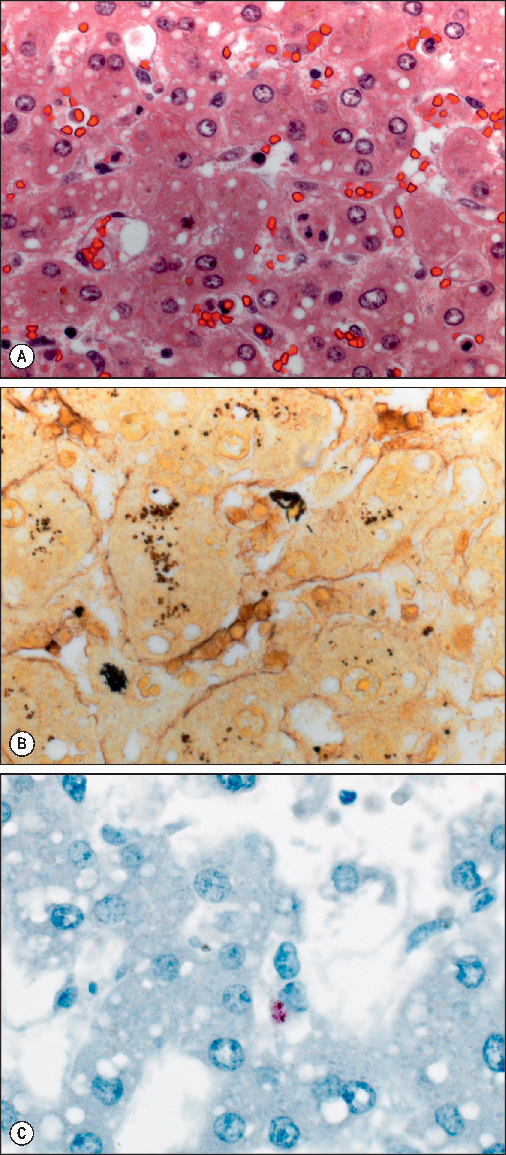 Figure 7.27, Streptobacillus moniliformis (rat-bite fever). (A) Fatal case of rat-bite fever in a patient who was exposed to infected rodents. Liver shows small-droplet fatty change and erythrophagocytosis within hepatic sinusoids. (H&E stain.) (B) Silver stain (Steiner) shows single and aggregated bacilli in hepatic sinusoids. (C) In situ hybridization for S. moniliformis shows intracellular staining of bacterial nucleic acids (immunoalkaline phosphatase staining, naphthol fast red substrate with haematoxylin counterstain).