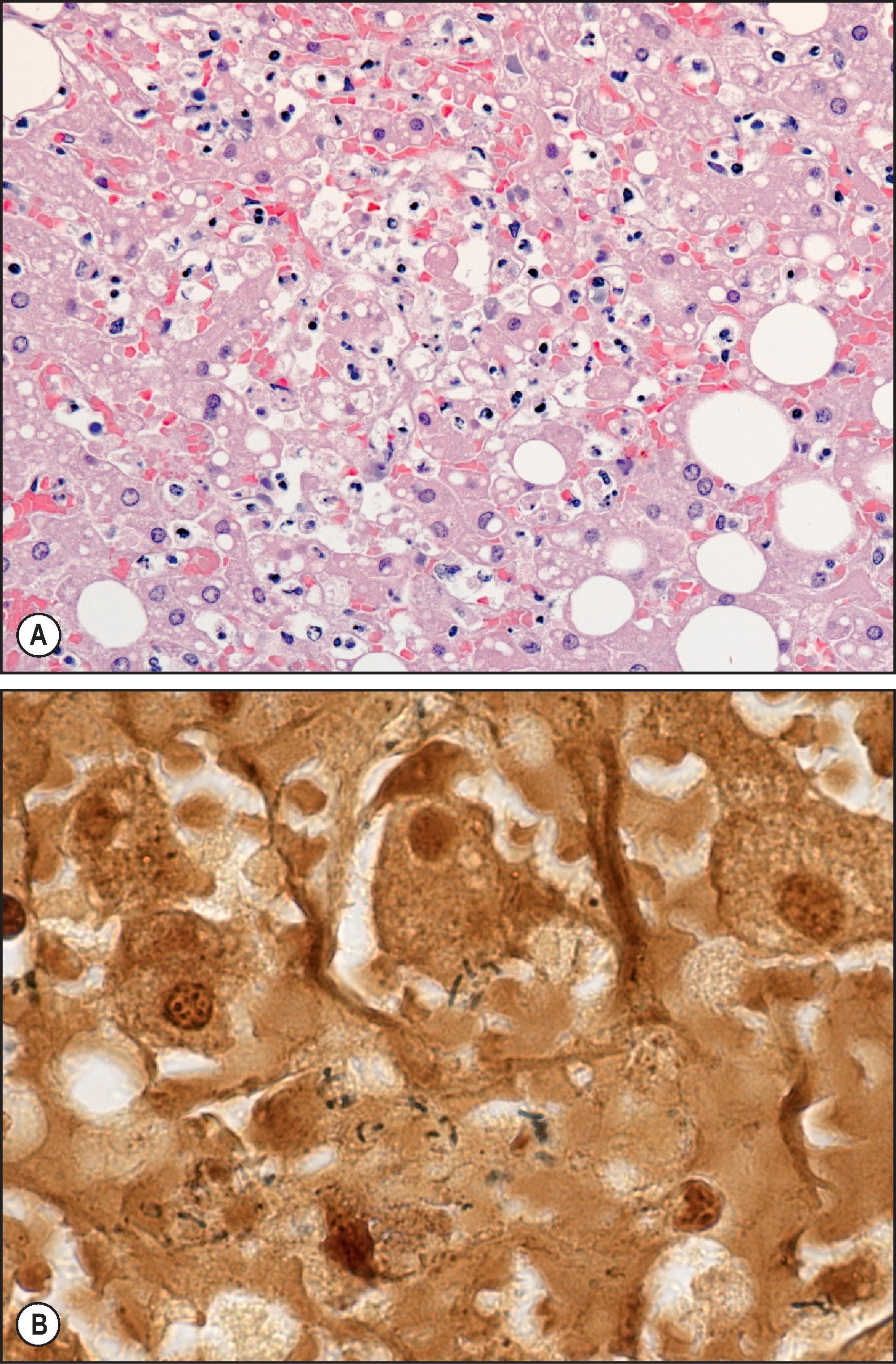 Figure 7.28, Capnocytophaga infection. Fatal case of Capnocytophaga canimorsus infection in an asplenic patient with a history of a dog bite. (A) Low-power photomicrograph of the liver shows focal necrosis and aggregate of predominantly acute inflammatory cell. (H&E stain.) (B) Multiple bacilli are seen in this silver stain (Steiner). Diagnosis of the infection was by polymerase chain reaction from formalin-fixed paraffin-embedded tissue.