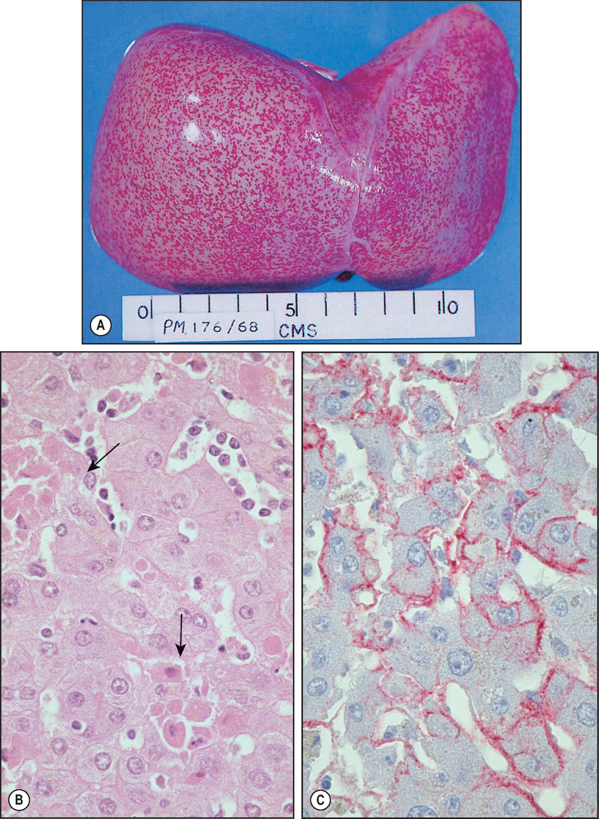 Figure 7.3, Lassa fever. (A) Autopsy liver from a Lassa fever patient showing foci of haemorrhagic necrosis under the capsule. (B Eosinophilic necrosis (arrows) and minimal inflammation in fatal Lassa fever. (H&E stain.) (C) Using immunohistochemistry, abundant Lassa virus antigens are seen in a membranous pattern surrounding hepatocytes and sinusoidal lining cells (immunoalkaline phosphatase staining, naphthol fast red substrate with haematoxylin counterstain).