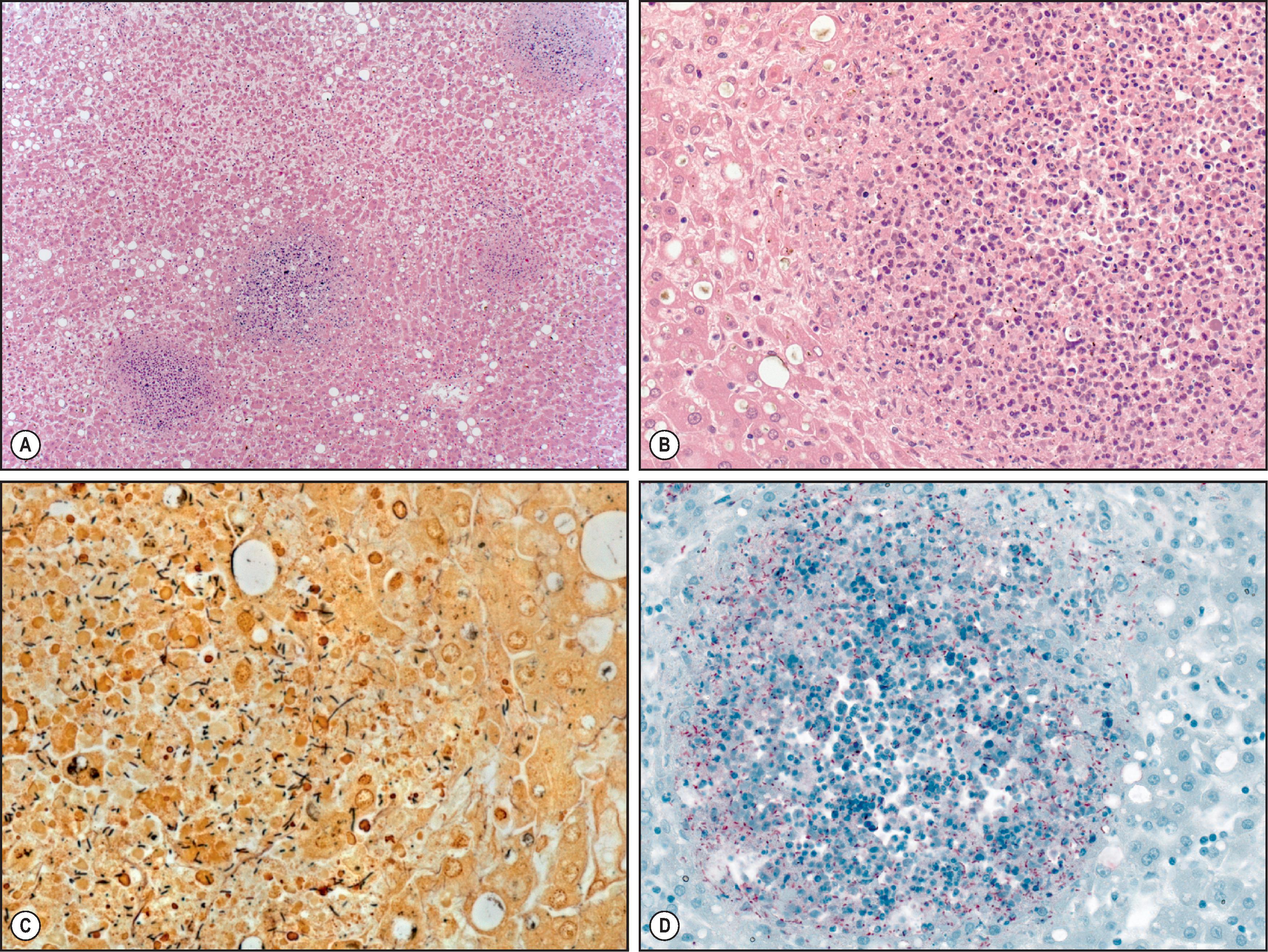 Figure 7.31, Burkholderia pseudomallei (melioidosis) hepatic abscesses. (A) Low-power image of multiple well-demarcated hepatic abscesses. (B) Higher-power image demonstrating abundant neutrophilic inflammation, necrosis and cell debris. (H&E stain.) (C) Warthin–Starry stain for bacteria highlights abundant rod-shaped bacteria within the abscess. (D) Immunohistochemical assay targeting Burkholderia pseudomallei highlights the discrete bacteria, confirming the diagnosis.