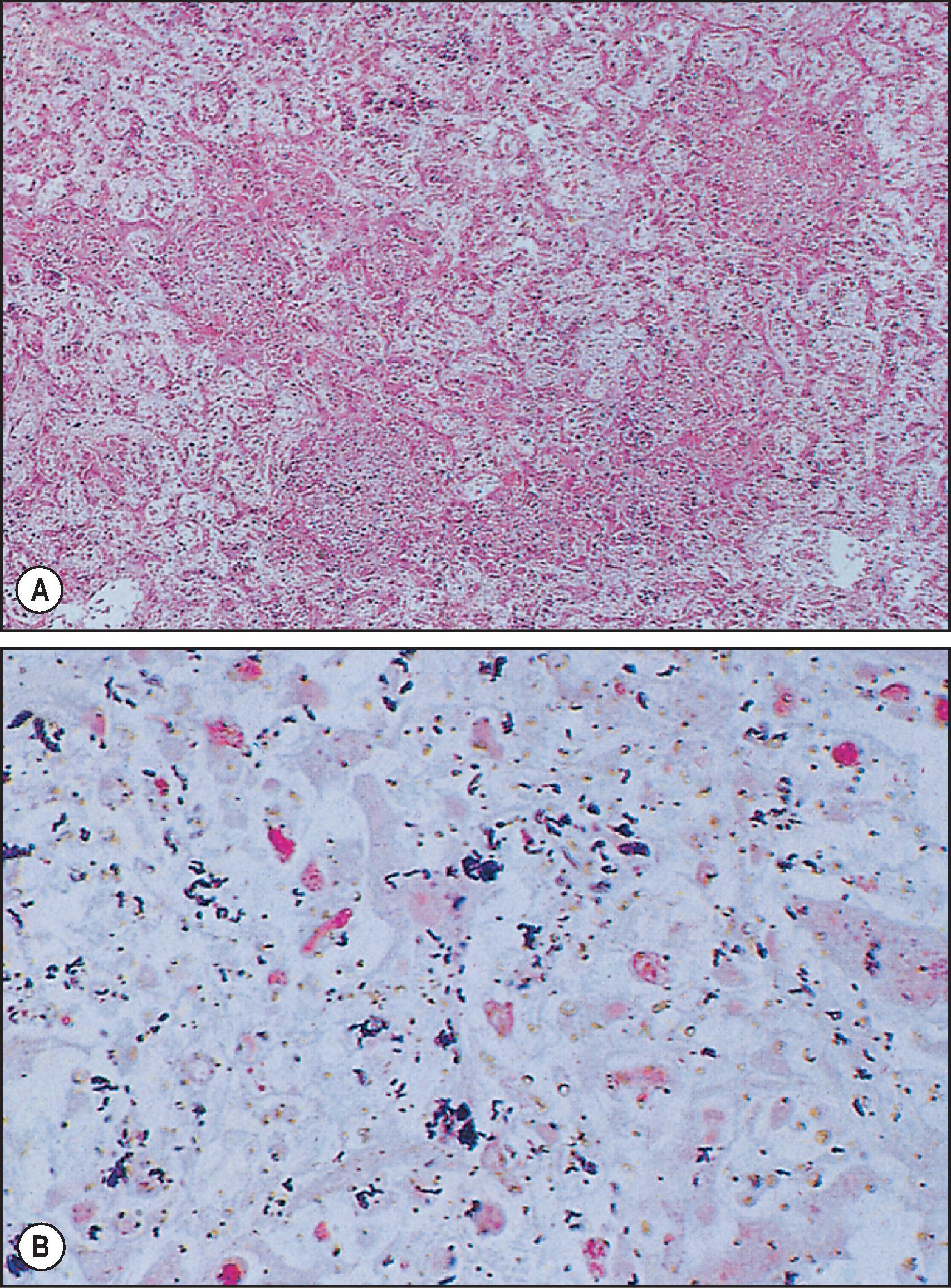 Figure 7.32, Listeriosis. (A) Necrotic granulomas in the parenchyma. (H&E stain.) (B) Gram stain shows abundant Gram-positive bacilli.