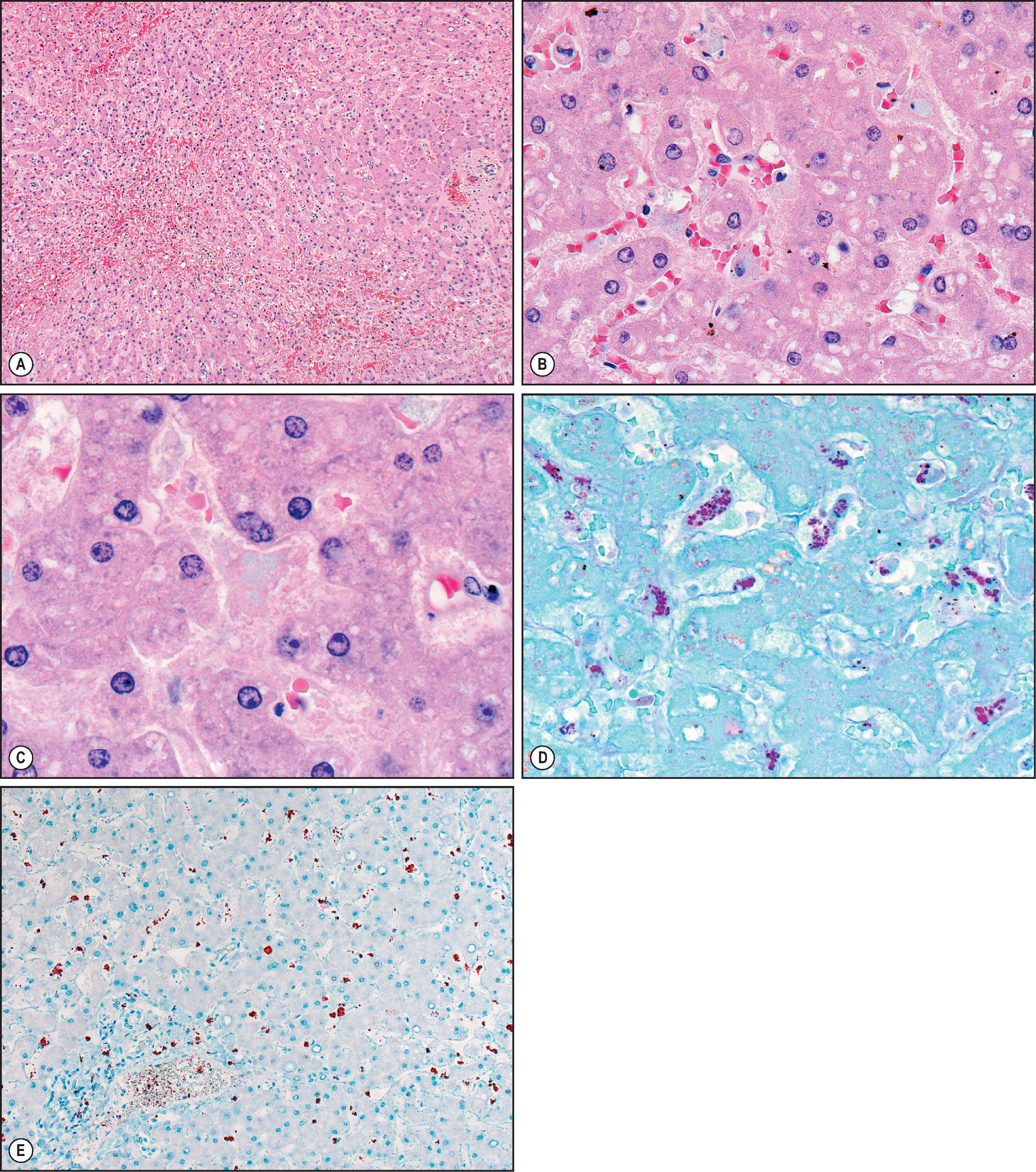 Figure 7.33, Whipple disease. (A) At low power, features of sinusoidal congestion are apparent. (B, C) However, the pale blue-grey tinctorial quality of Kupffer cell cytoplasm is appreciated at higher magnification. (H&E stain.) (D) Periodic acid-Schiff stain after diastase digestion (PAS-D) highlights the bacteria within the cytoplasm of Kupffer cells. (E) Immunohistochemical stain for Tropheryma whipplei highlights abundant bacterial antigens.