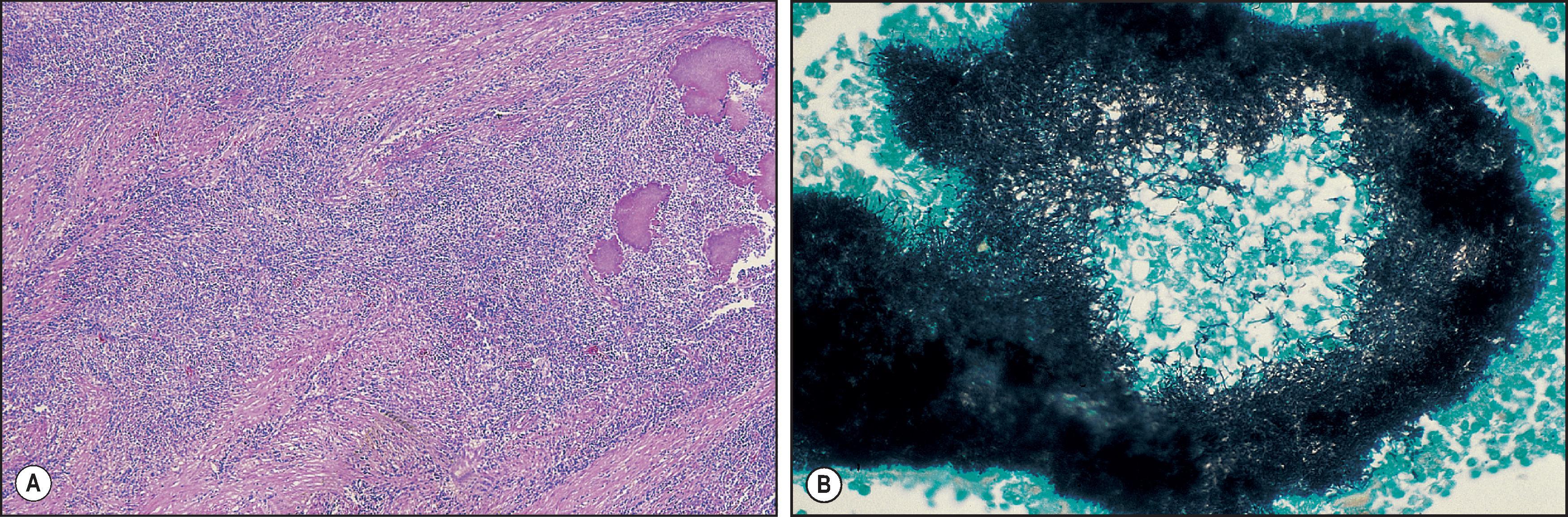 Figure 7.35, Actinomycosis. (A) Liver abscess with bacterial colonies in the purulent inflammation. (H&E stain.) (B) Silver stain shows fine, branching bacilli within the colony.