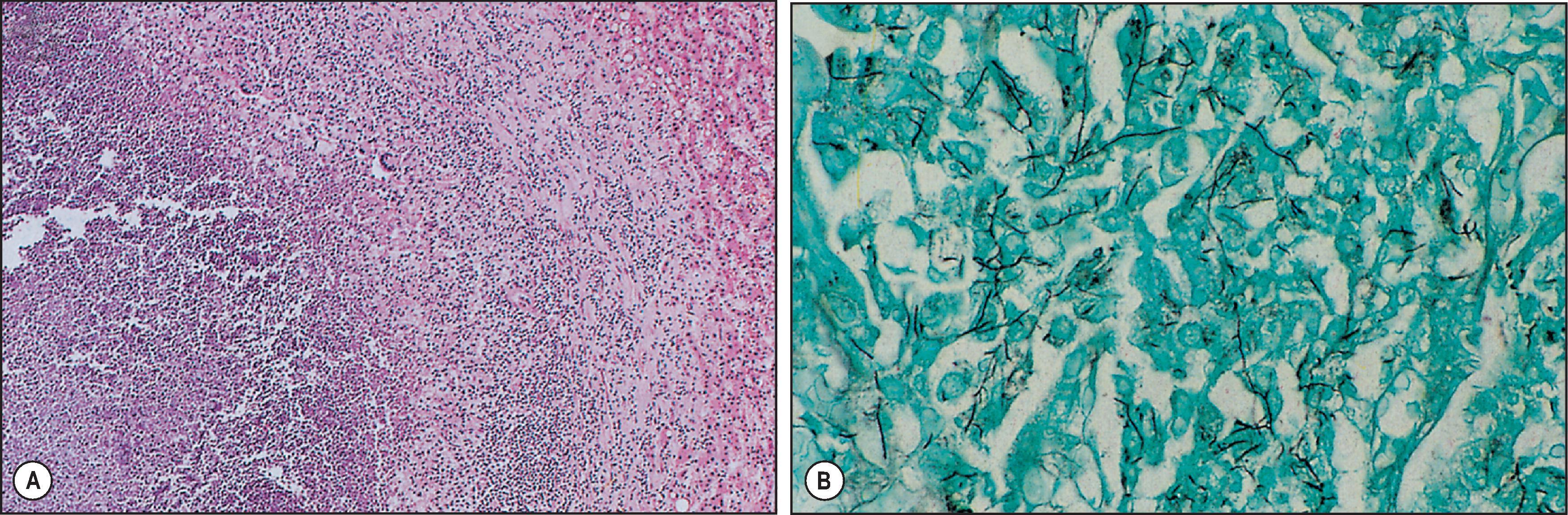 Figure 7.36, Nocardiosis. (A) Edge of a liver abscess with a purulent centre and a granulomatous border; note the giant cell. (H&E stain.) (B) Clusters of thin, branching filaments of Nocardia asteroides within the abscess. (Grocott stain.)
