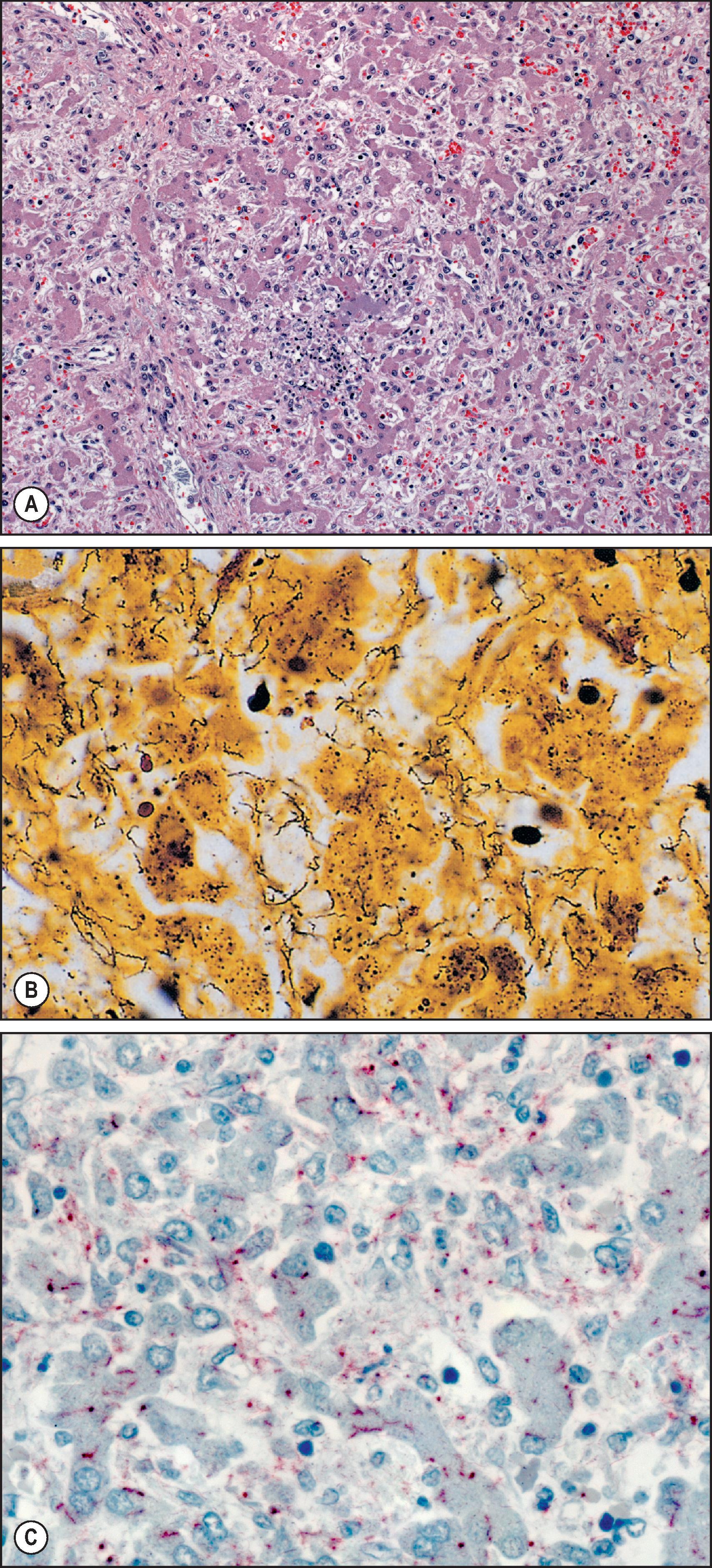 Figure 7.37, Syphilis. (A) Liver showing focal necrosis and inflammation and the typical diffuse sinusoidal fibrosis with attenuation of the liver plates (trichrome stain). (B) Focal lesions contain abundant silver-positive spirochetes (Warthin–Starry stain). (C) Immunohistochemical assays showing abundant spirochaetes and granular bacterial antigens. (Immunoalkaline phosphatase staining, naphthol fast red substrate with haematoxylin counterstain.)