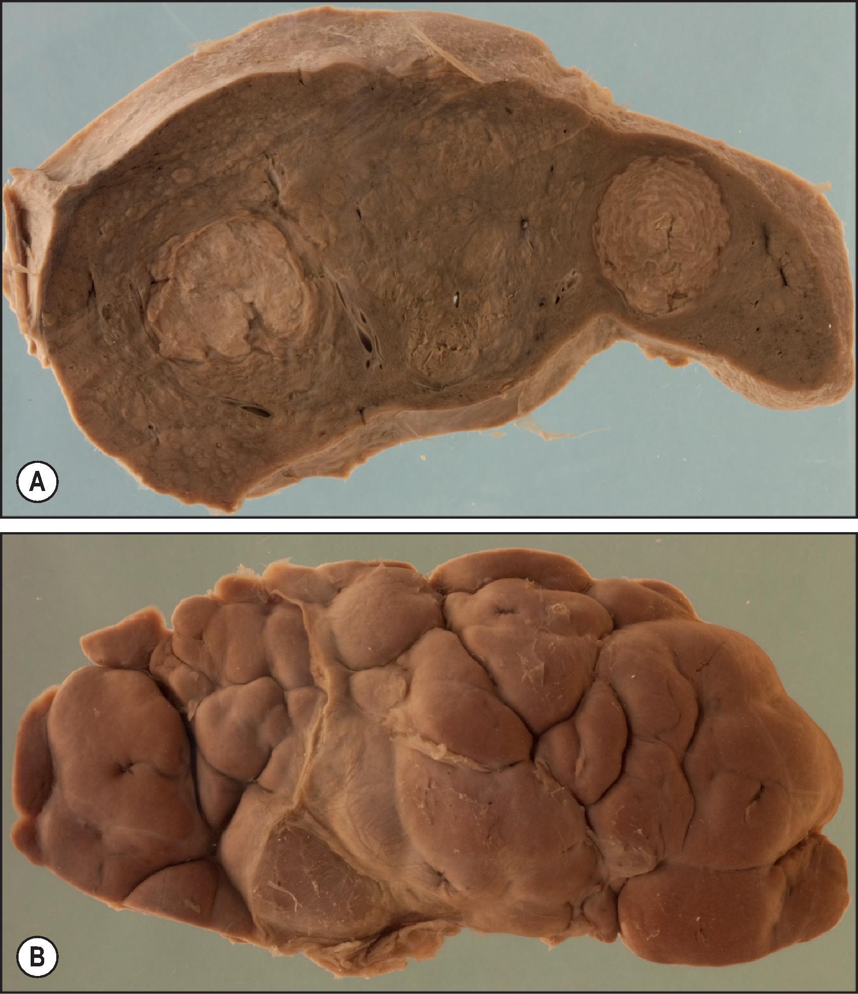 Figure 7.38, Tertiary syphilis. (A) Coronal liver section showing two particularly large gummas. (B) Fibrous healing has produced the deep fissures and coarse nodularity of hepar lobatum.