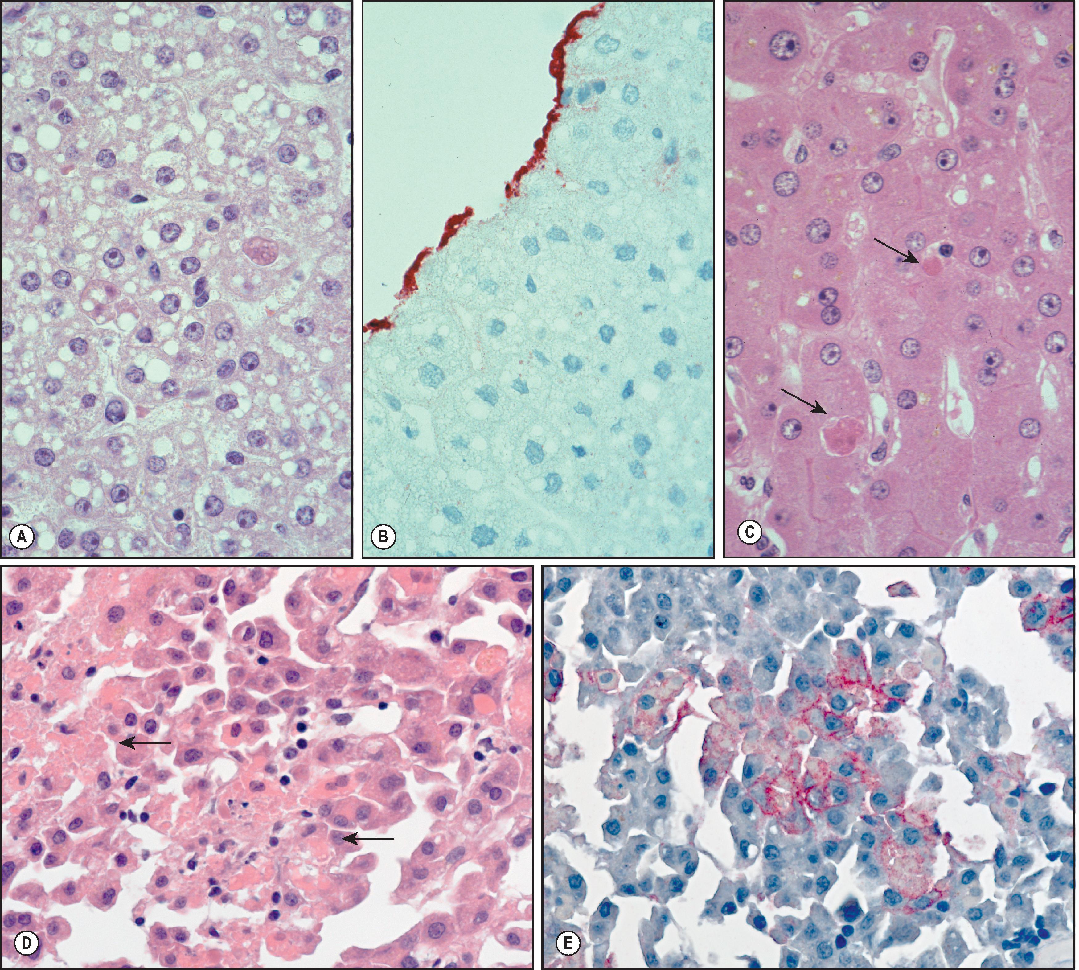 Figure 7.4, Other arenaviruses. (A, B) Bolivian haemorrhagic fever (Machupo virus). (A) Focal hepatocellular necrosis and small-droplet fatty change. (B) Immunostaining of viral antigens in serosal cells on surface of liver. (C) Argentine haemorrhagic fever (Junin virus). Liver with focal acidophilic change (arrows) and sinusoidal dilation. (D, E) Lujo virus (novel Old World arenavirus in southern Africa). Hepatocyte necrosis (arrows) without prominent inflammatory cell infiltrates (D) and immunostaining of Lujo virus antigens in a membranous pattern around infected hepatocytes (E). (F, G) Lymphocytic choriomeningitis virus. Extensive hepatocellular necrosis with minimal inflammation in a liver recipient from an infected donor (F) and immunostaining of viral antigens in same liver (G).Figure 7.4 cont’d(H) Electron micrograph of lymphocytic choriomeningitis virus isolated in culture cells from the cerebrospinal fluid of another recipient. (A, C, D and F, H&E stain; B, E and G, immunoalkaline phosphatase staining, naphthol fast red substrate with haematoxylin counterstain.)