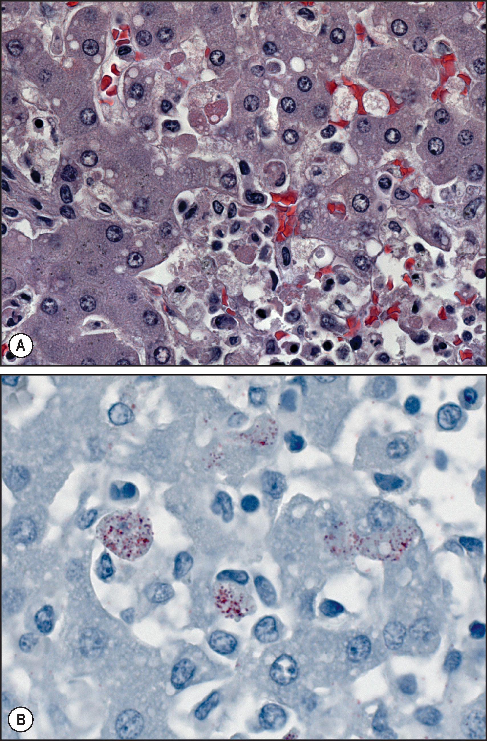 Figure 7.7, Enterovirus hepatitis. (A) Liver from a fatal paediatric enterovirus case. Note focal areas of necrosis showing swollen, foamy hepatocytes surrounded by a mixed inflammatory reaction. No viral inclusion can be seen in these infections by light microscopy. (H&E stain.) (B) Immunostaining of enteroviral antigens in same case. Note focal intrahepatic punctate staining pattern. Coxsackievirus B3 was detected by polymerase chain reaction from formalin-fixed tissues in this case. (Immunoalkaline phosphatase staining, naphthol fast red substrate with haematoxylin counterstain.)