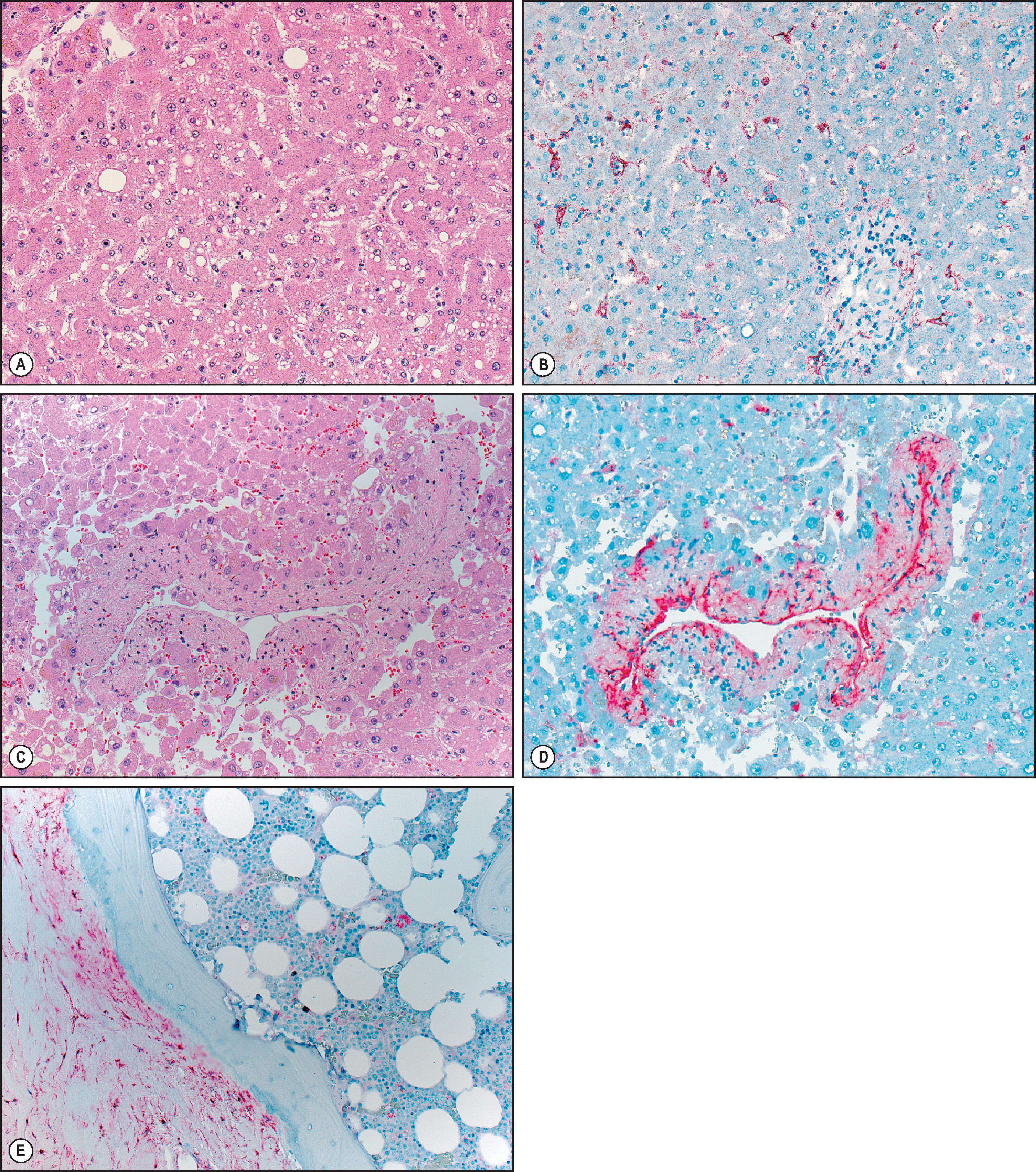 Figure 7.8, Chikungunya virus (ChikV). (A) Liver section from a fatal case of ChikV demonstrating nonspecific features in the lobular parenchyma. (H&E stain.) (B) Immunostaining of ChikV antigens in portal-based fibroblasts and Kupffer cells lining the sinusoids. (C) Large vein surrounded by hepatocytes with mild small-droplet steatosis. (H&E stain.) (D) Immunostaining of ChikV antigens throughout the smooth muscle vascular wall and (E) within the dense fibrous periosteum of bone (immunoalkaline phosphatase staining, naphthol fast red substrate with haematoxylin counterstain).