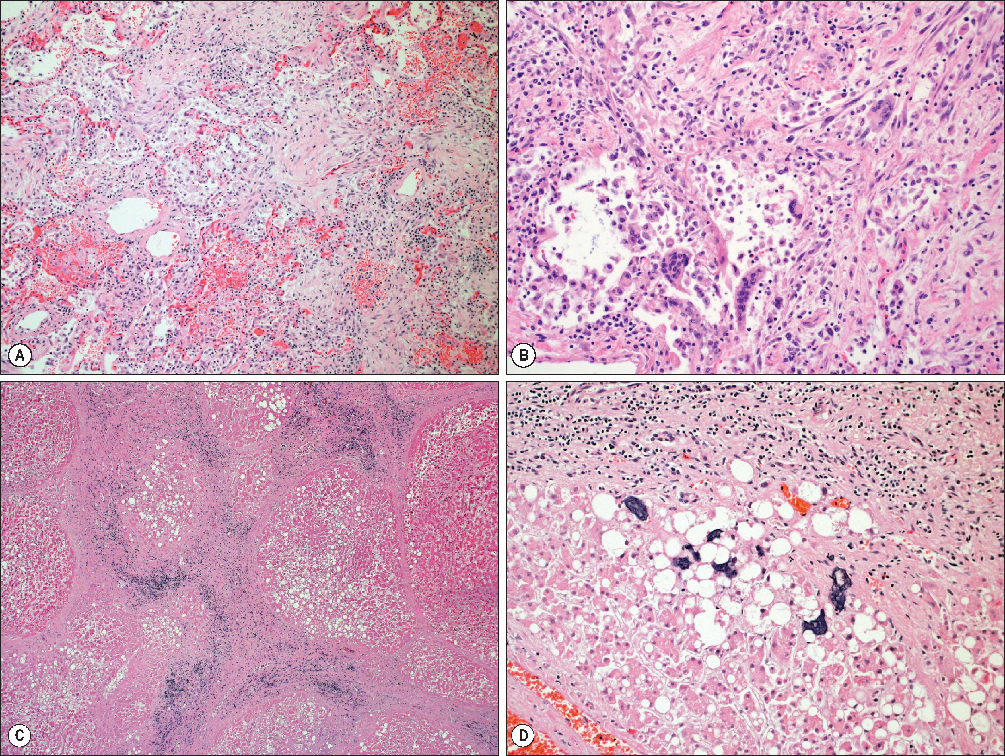 Figure 7.9, SARS-CoV-2 (COVID-19). (A) Organizing pneumonia with fibroblast proliferation, type 2 pneumocyte hyperplasia, chronic inflammation and haemorrhage in a patient who died approximately 2 weeks after diagnosis. (B) Organizing pneumonia with multinucleated, syncytial-appearing pneumocytes. (C) Cirrhotic liver due to alcoholic steatohepatitis in a fatal case of SARS-CoV-2. (D) Focal basophilic structures are identified in the hepatic sinusoids.