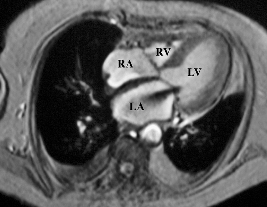 Mitral regurgitation. Axial CMR shows a jet-like signal void in the left atrium due to moderate mitral regurgitation. LA = left atrium, LV = left ventricle, RA = right atrium, RV = right ventricle. *