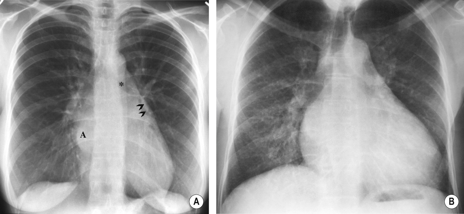 (A) Classical appearance of rheumatic mitral stenosis. PA CXR. The heart size is normal. The enlarged left atrium (A) displaces the left bronchus upwards (asterisk) and creates a right retrocardiac double density. The left atrial appendage is enlarged (arrowheads). There is severe pulmonary venous hypertension. (B) Severe mitral valve disease. Pulmonary haemosiderosis in mitral stenosis. Long-standing severe mitral stenosis. The heart and left atrium are enlarged. Bilateral nodular interstitial prominence is due to pulmonary haemosiderosis.