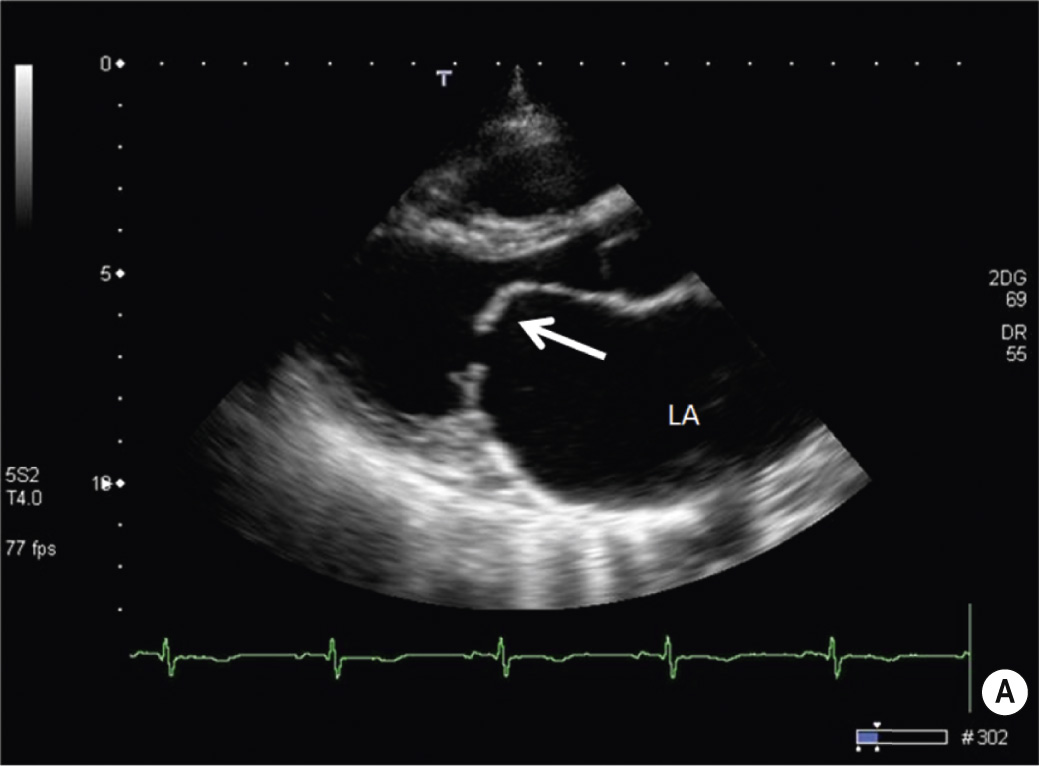 Mitral stenosis. (A) Echocardiography (parasternal long axis) shows marked thickening of mitral leaflets with restricted mitral valve orifice (doming anterior leaflet). Left atrial (LA) enlargement is evident. (B) Cine-MRI frame of mitral stenosis. A small flow void directed from left atrium (LA) to left ventricle (LV) is visible (arrows), due to mild mitral stenosis. Left atrium is enlarged. **