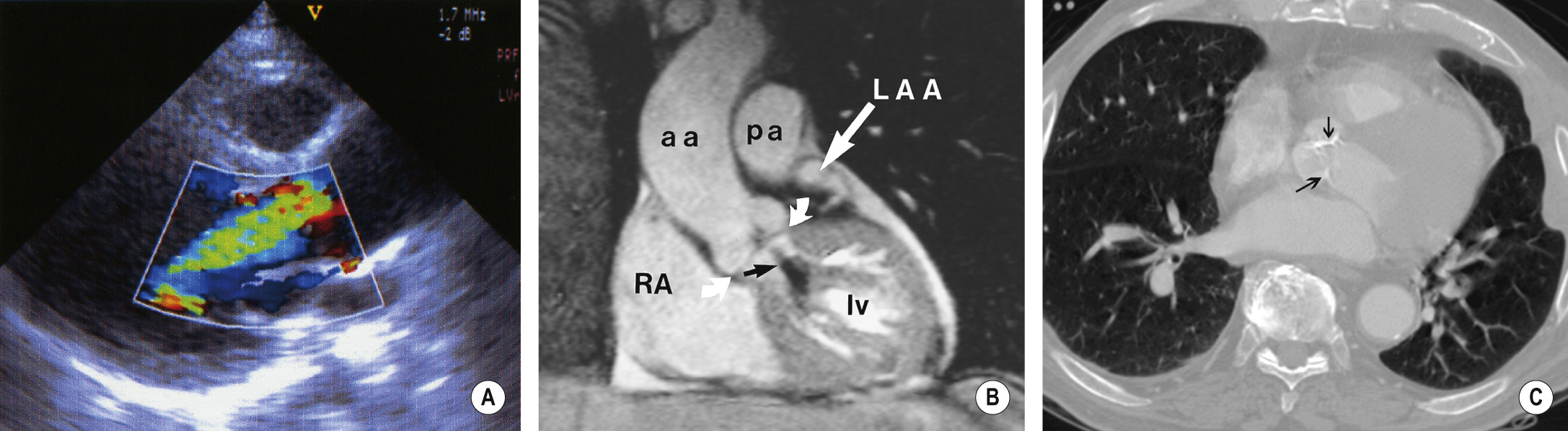 (A) Colour flow Doppler image taken in the parasternal long-axis view. A broad-based jet in a patient with severe aortic regurgitation. (B) Coronal MRA. Oblique breath-hold cine-MRA in a patient with mild aortic regurgitation indicated by the black area of signal loss (black arrow). The left atrial appendage (LAA) is embedded in epicardial fat. There is mild dilatation of the ascending aorta (aa) as a result of the aortic regurgitation. Between curved arrows = aortic valve. lv = left ventricle, pa = pulmonary artery, RA = right atrium. (C) Aortic valve calcification. Axial CT at aortic valve level shows calcification of the aortic leaflets (arrows).