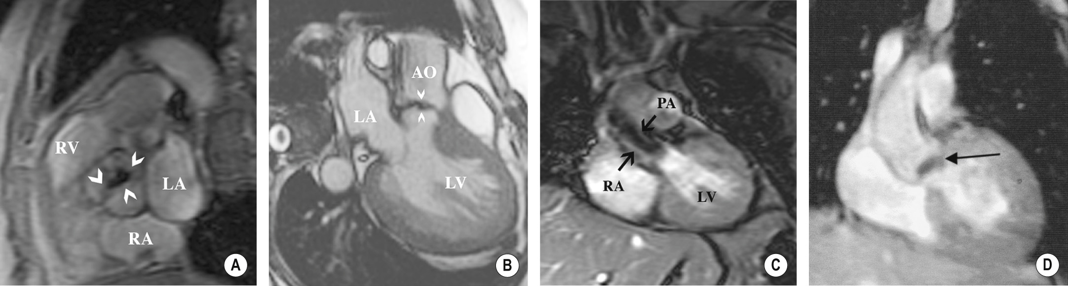 Tricuspid aortic stenosis. CMR of (A) aortic valve view, diastolic image, (B) left ventricular outflow tract (LVOT) view, systolic image, and (C) coronal, ascending aorta view. In the aortic valve view (A), fusion of the commissures of a markedly thickened valve is noted (arrowheads). Doming of the valve leaflets is noted in the LVOT projection (arrowheads) (B). The systolic image demonstrates the turbulent jet (arrows) from aortic stenosis (C). (D) Coronal gradient-echo MRI image (ECG gated) through the left ventricular outflow tract and aortic valve in a patient with calcific aortic stenosis. There is calcification of the aortic valve, which produces a signal void (arrow). AO = ascending aorta, LA = left atrium, LV = left ventricle, PA = pulmonary artery, RA = right atrium, RV = right ventricle. *