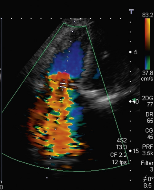 Tricuspid regurgitation. Echo colour Doppler demonstrates severe tricuspid insufficiency with mosaic effect occupying entirely the right atrium. **