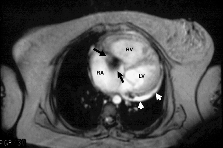 Axial systolic gradient-echo acquisition from a 24-year-old woman with primary pulmonary hypertension. The free wall right ventricular (RV) myocardium is hypertrophied. The heart is rotated toward the left and the interventricular septum is nearly in the coronal plane. The broad signal void jet (black arrows) of tricuspid regurgitation extends into the dilated right atrium (RA). Notice the small pericardial effusion (white arrows). LV = left ventricle. RV = right ventricle. •