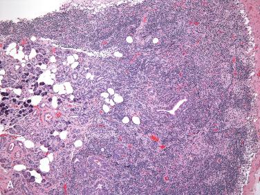 Fig. 19-1, Intranodal parotid parenchyma.