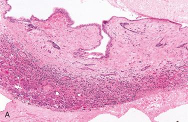 Fig. 19-11, Salivary duct cyst.