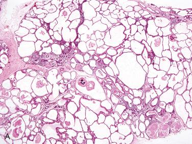 Fig. 19-12, Polycystic dysgenetic disease.