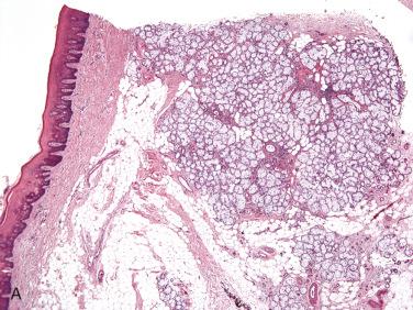 Fig. 19-2, Adenomatoid hyperplasia.