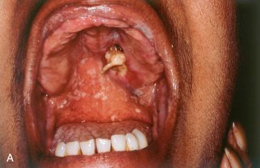 Fig. 19-3, Necrotizing sialometaplasia.