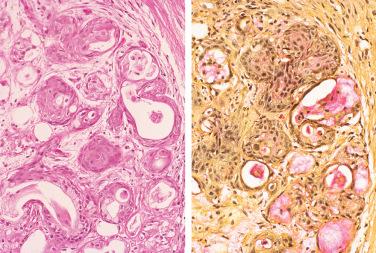 Fig. 19-5, Necrotizing sialometaplasia.