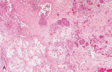 Fig. 19-6, Necrotizing sialometaplasia of the sinonasal tract.